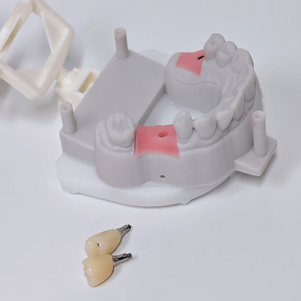 Zirconia Crown With Screw Retained