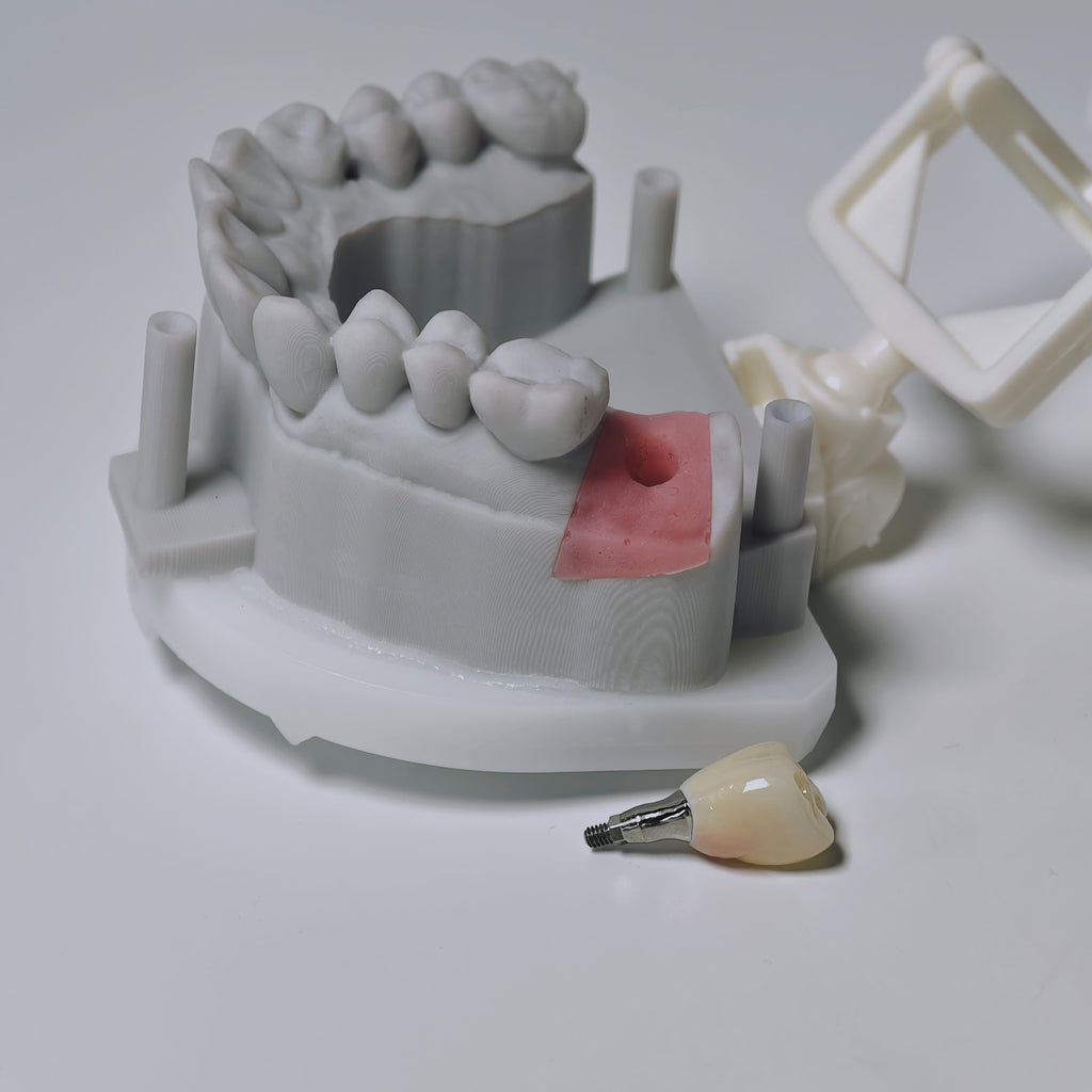Zirconia Crown With Screw Retained