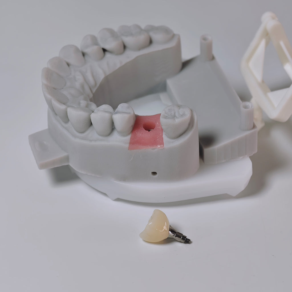 Zirconia Crown With Screw Retained