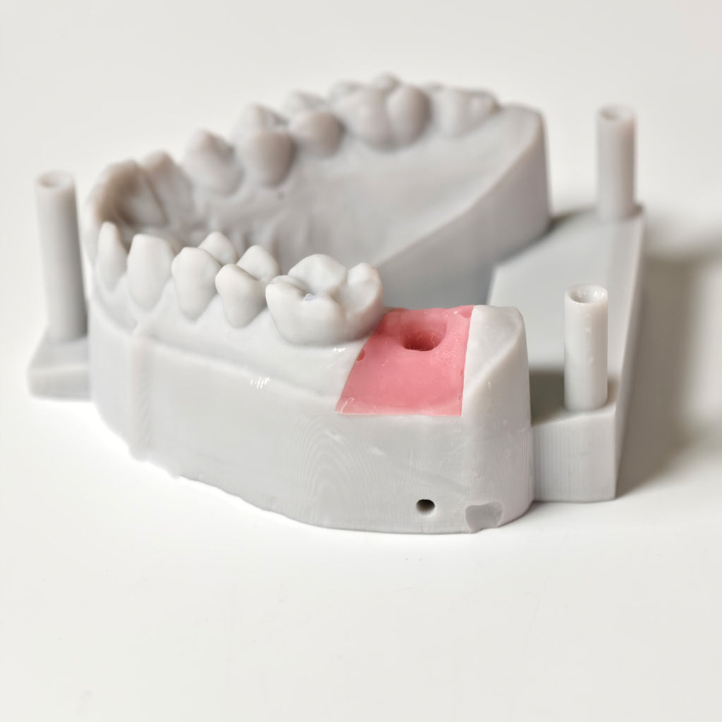 Zirconia Crown With Screw Retained