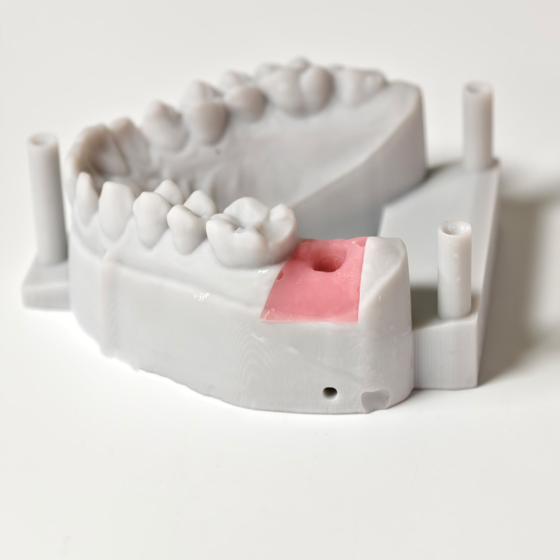 Zirconia Crown With Screw Retained