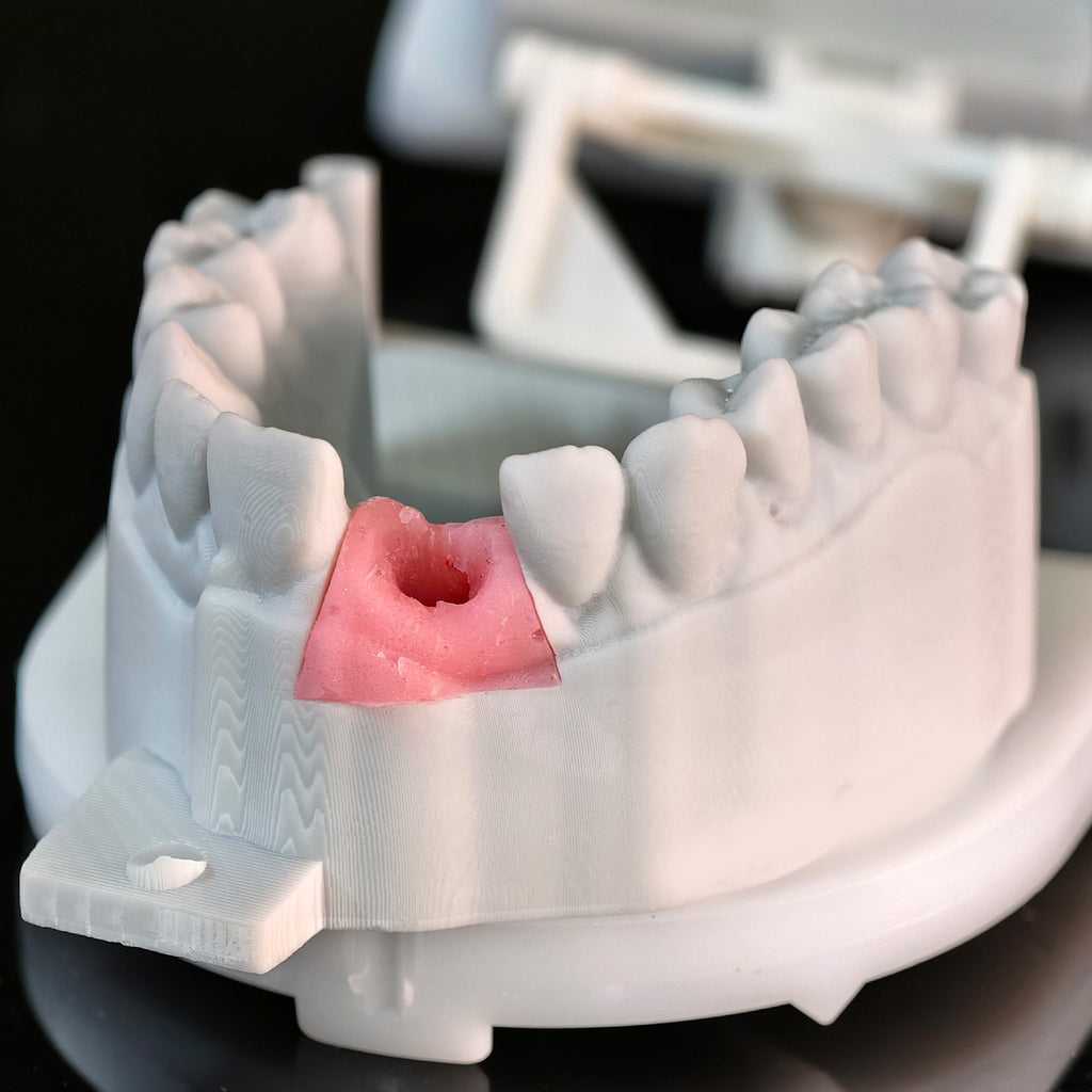 Zirconia Crown With Screw Retained