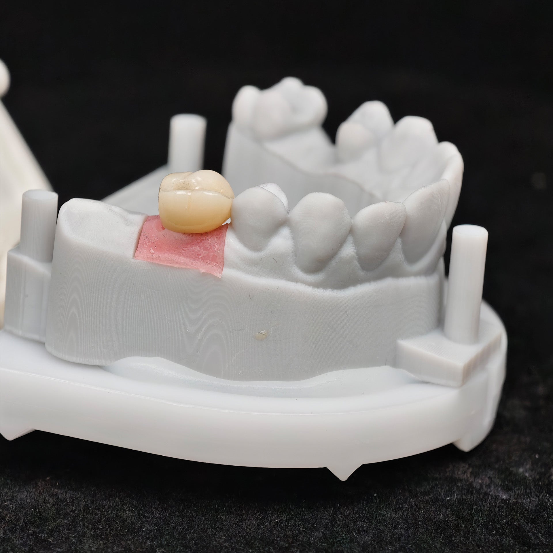 Zirconia Crown With Screw Retained