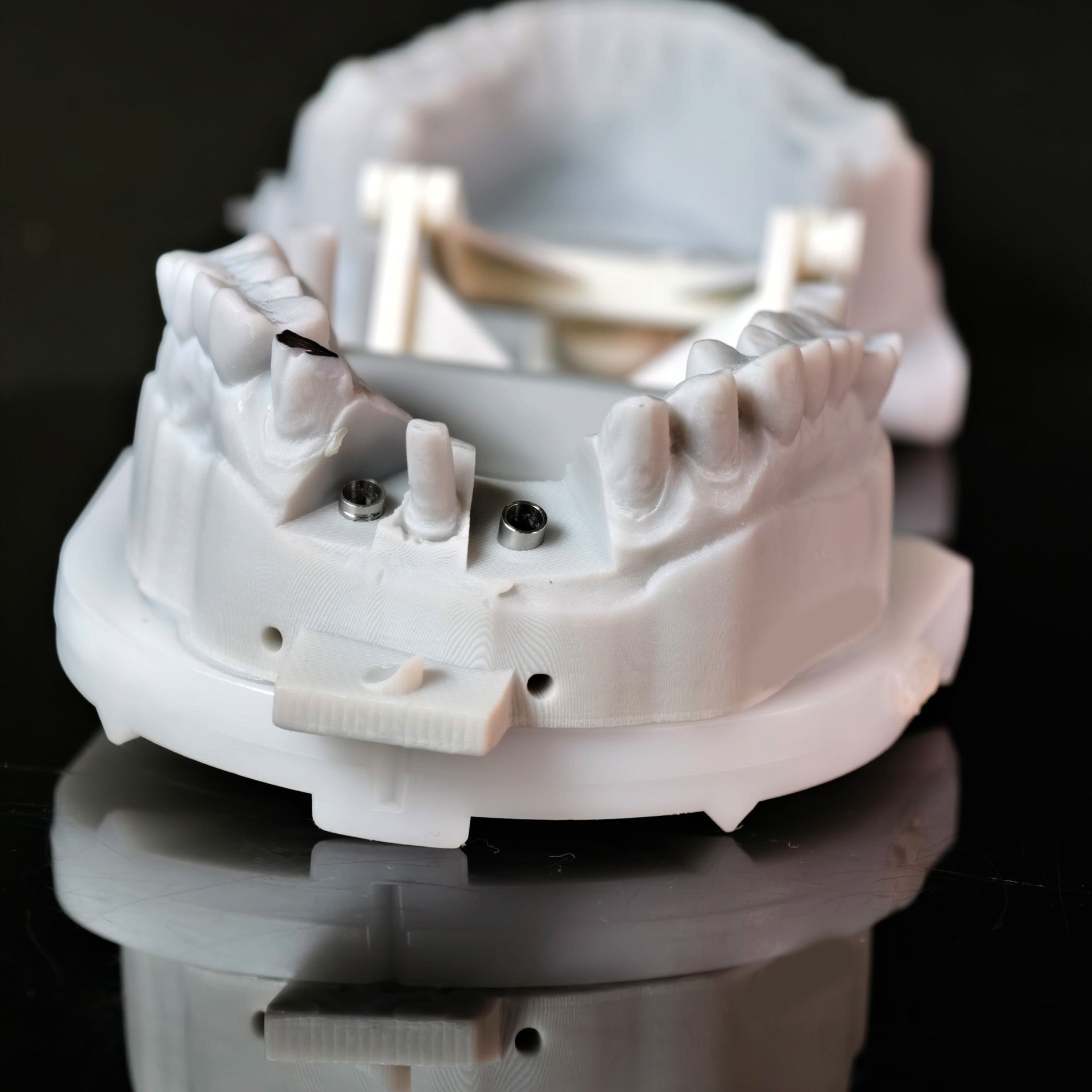Zirconia Crown With Screw Retained And Cement Retained And Ceramic Veneers