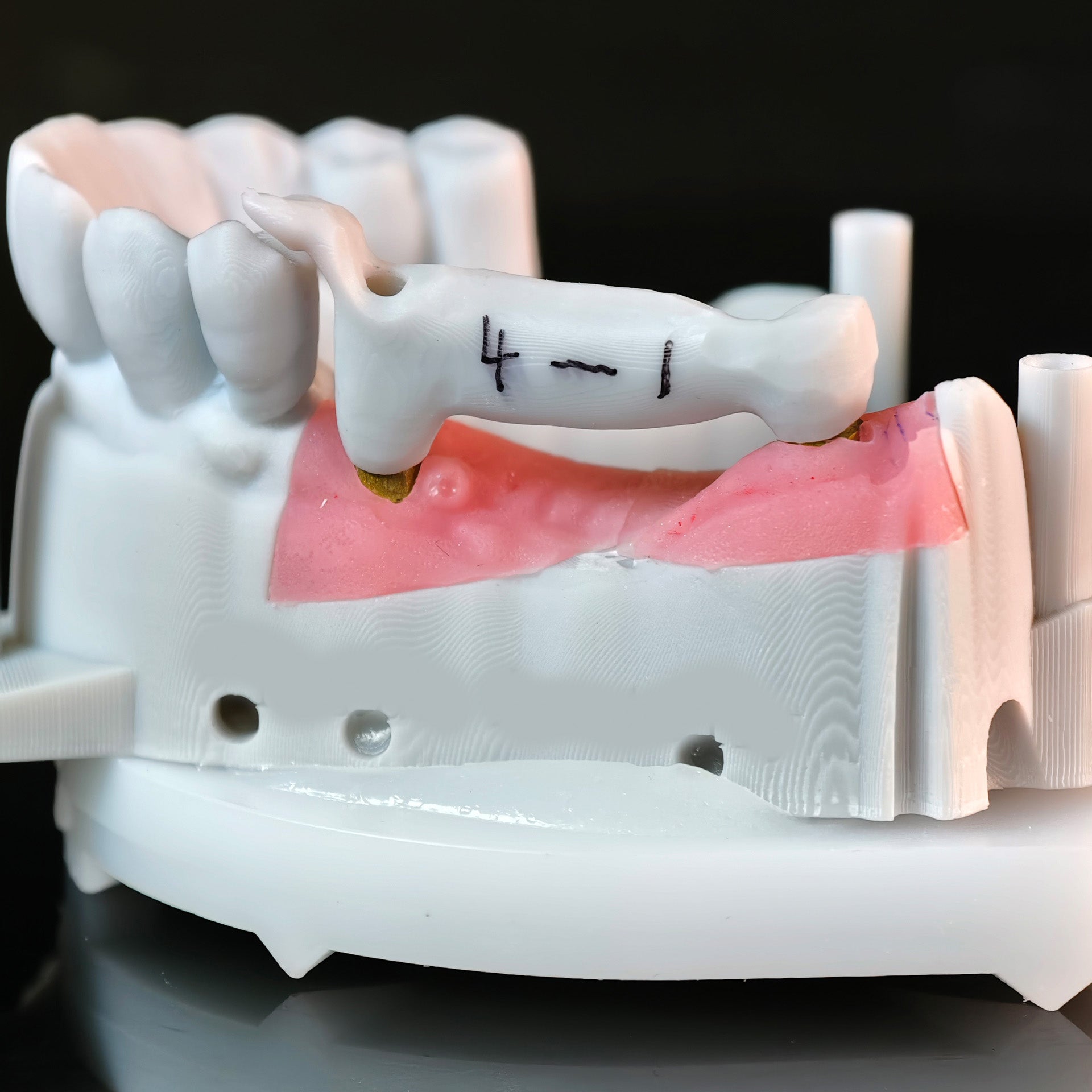 Zirconia Implant Bridge Screwmentable Dental Crown