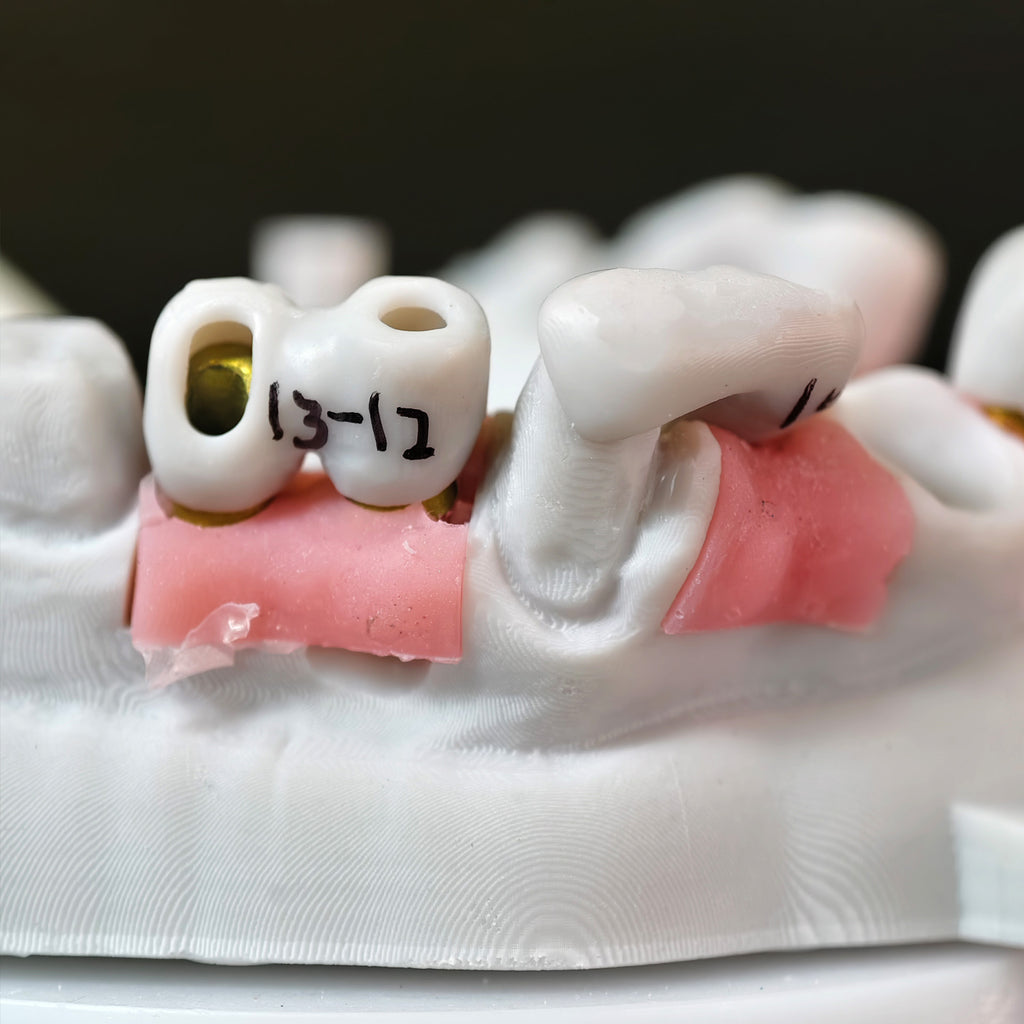Zirconia Implant Bridge Screwmentable Dental Crown