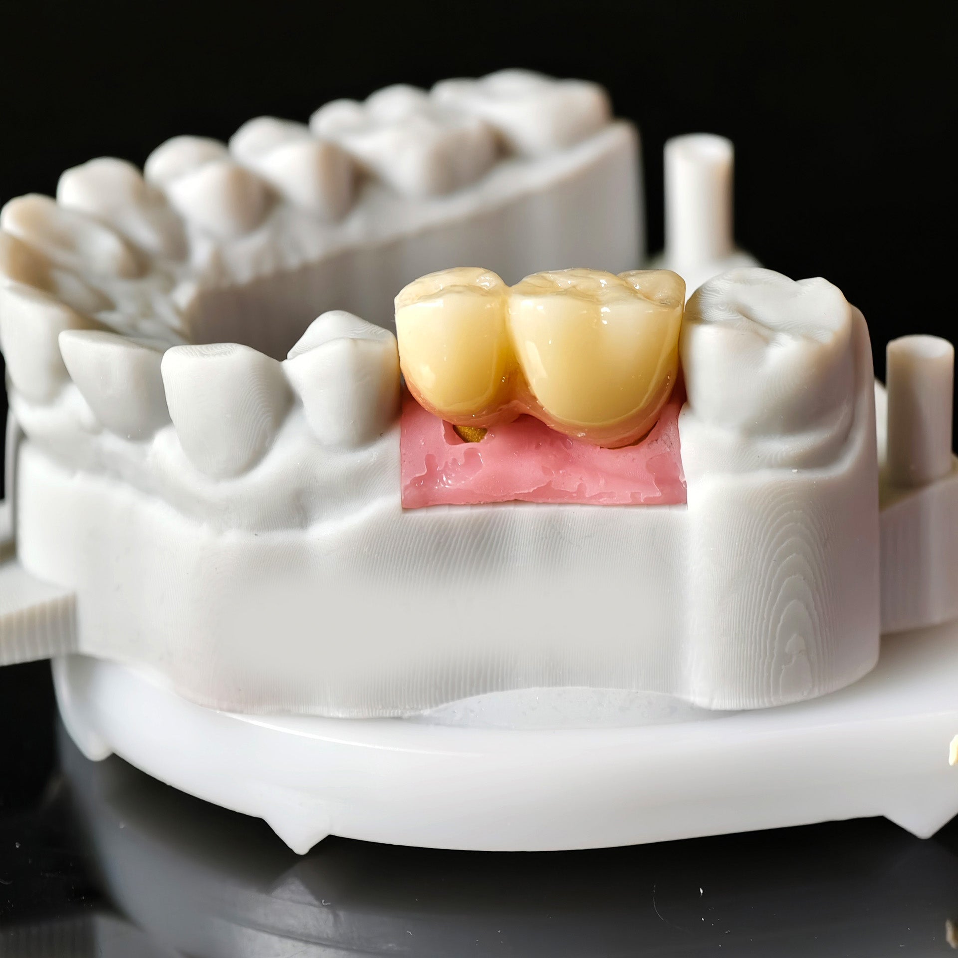 Zirconia Implant Bridge Screwmentable Dental Crown