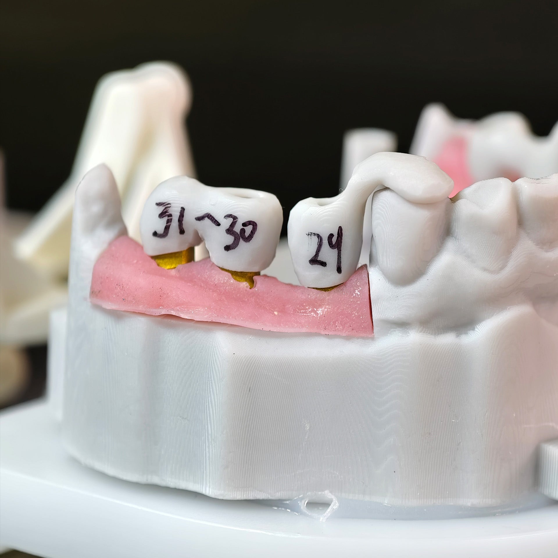 Zirconia Implant Bridge Screwmentable Dental Crown