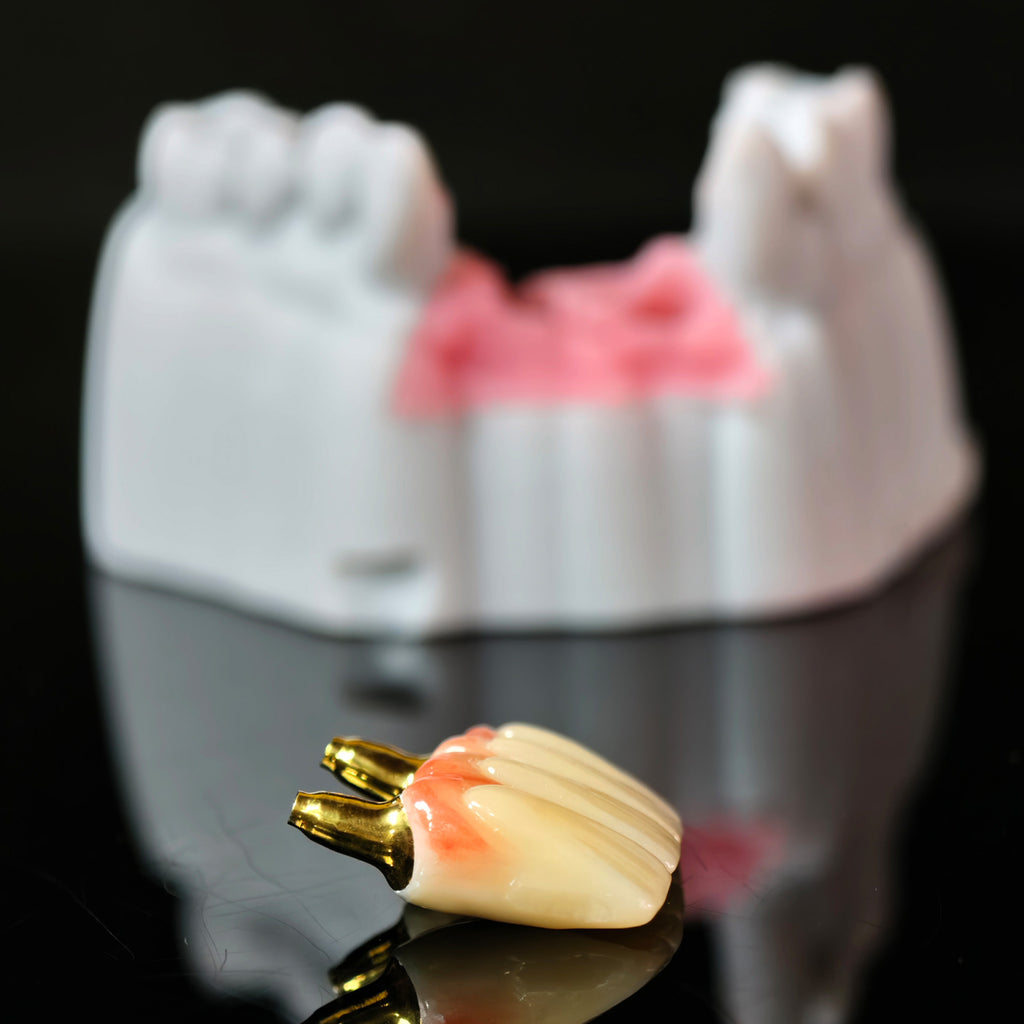 Zirconia Implant Bridge With Gold Plating
