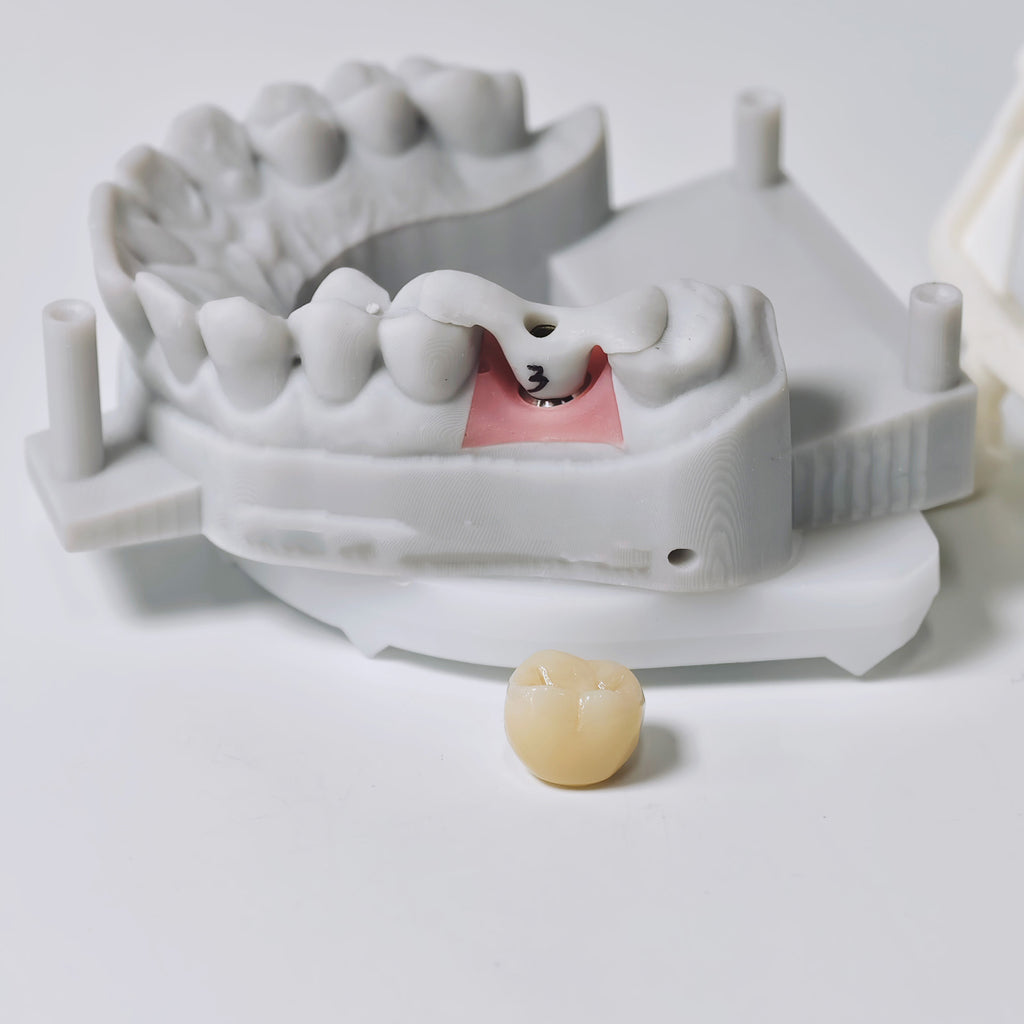 Zirconia Implant Crown Screwmentable Dental Crown