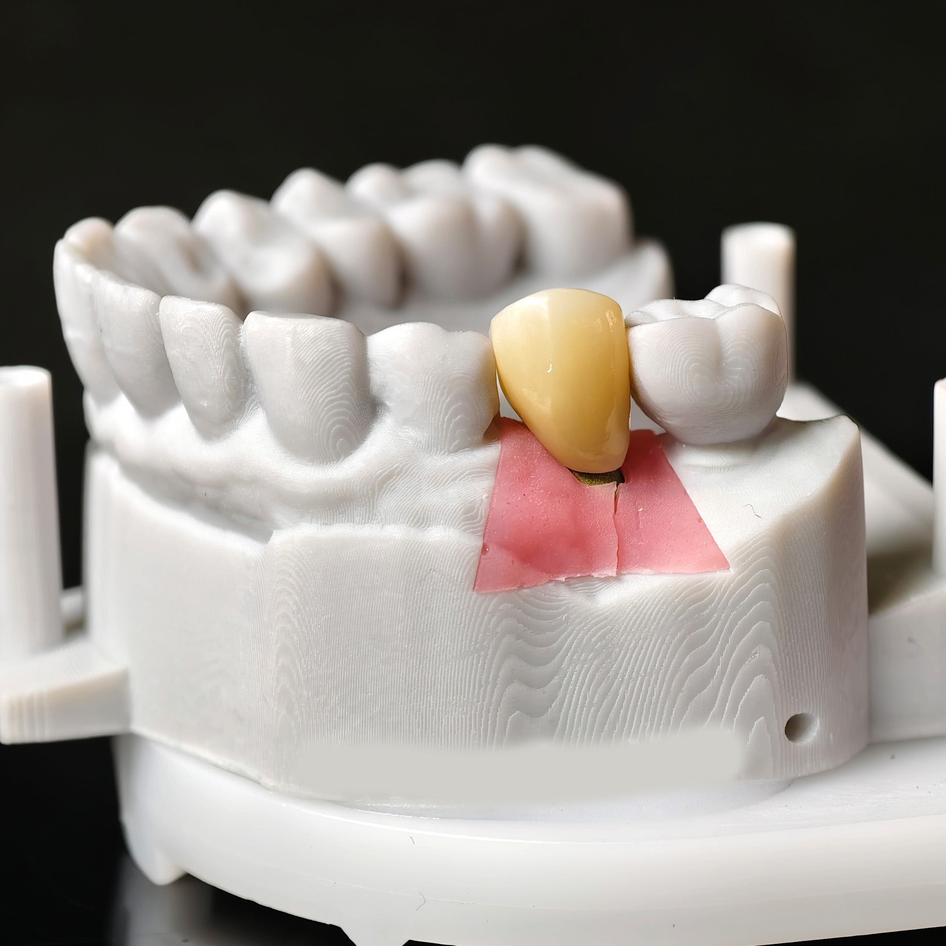 Zirconia Implant Crown Screwmentable Dental Crown