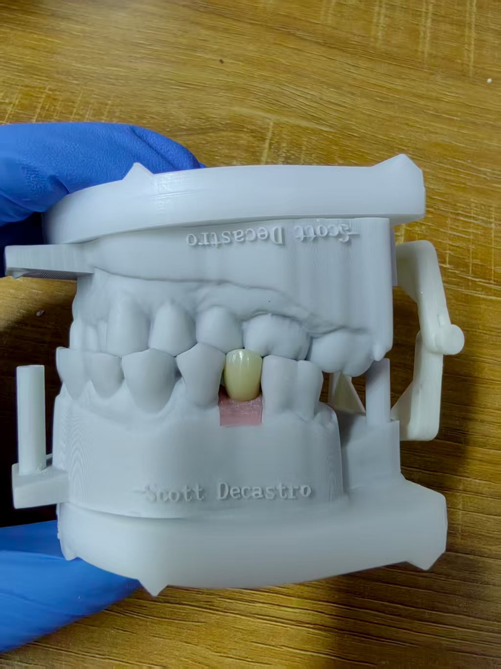 Zirconia Implant Crown Screwmentable Dental Crown