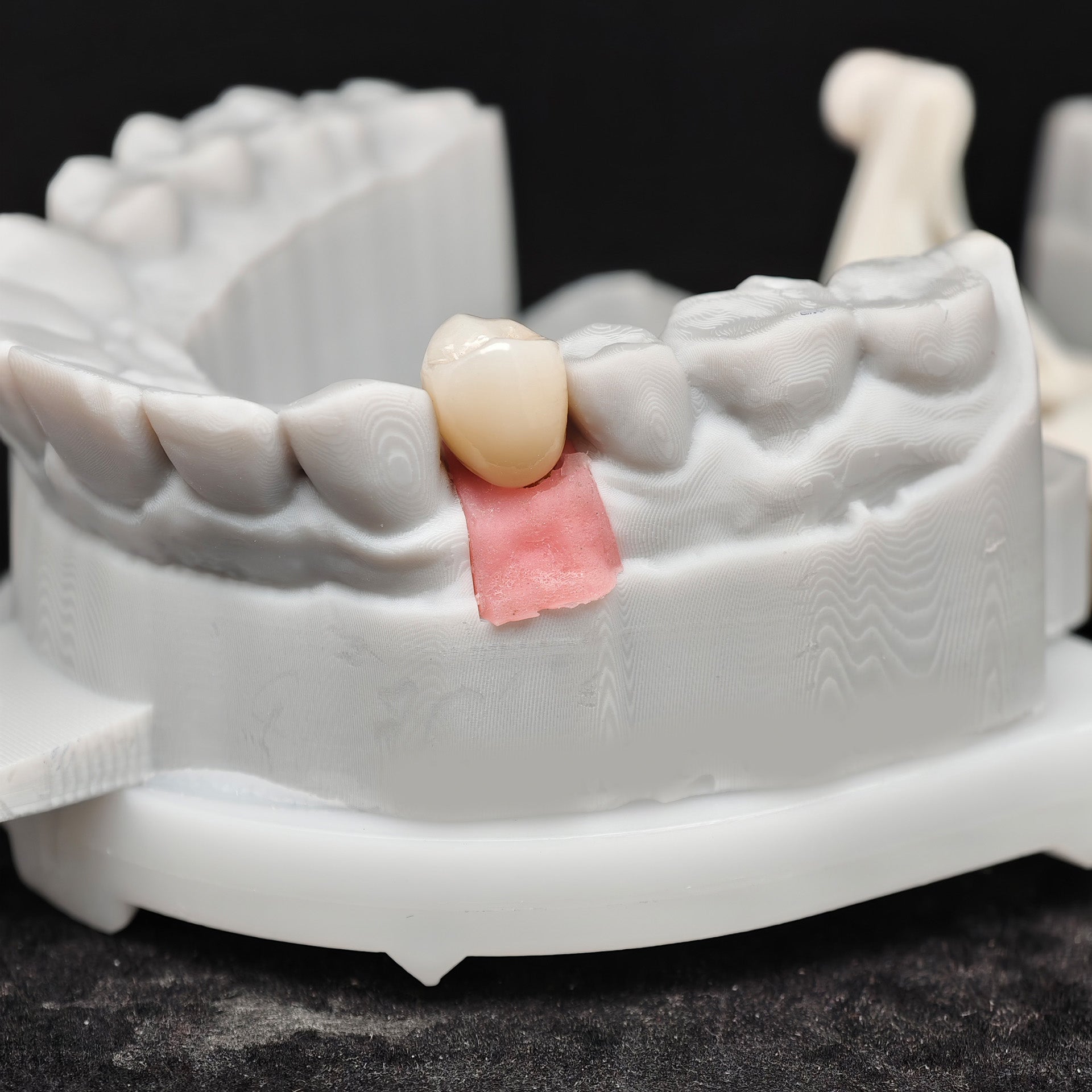 Zirconia Implant Crown Screwmentable Dental Crown
