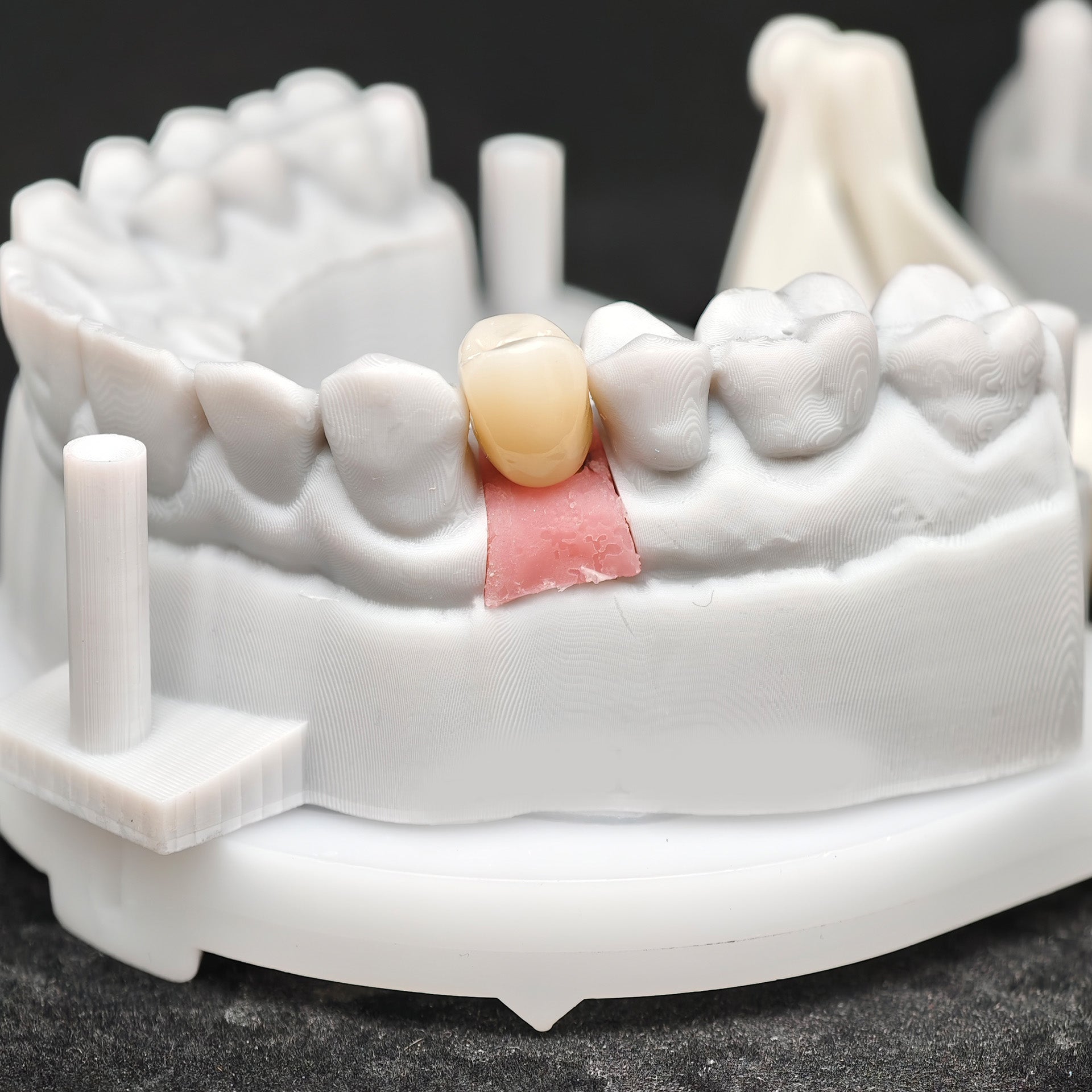 Zirconia Implant Crown Screwmentable Dental Crown