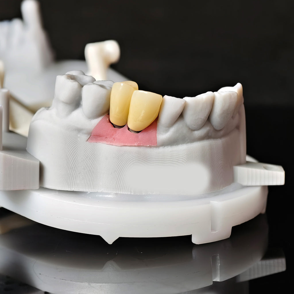 Zirconia Implant Crowns Screwmentable Dental Crown With Gold Plating