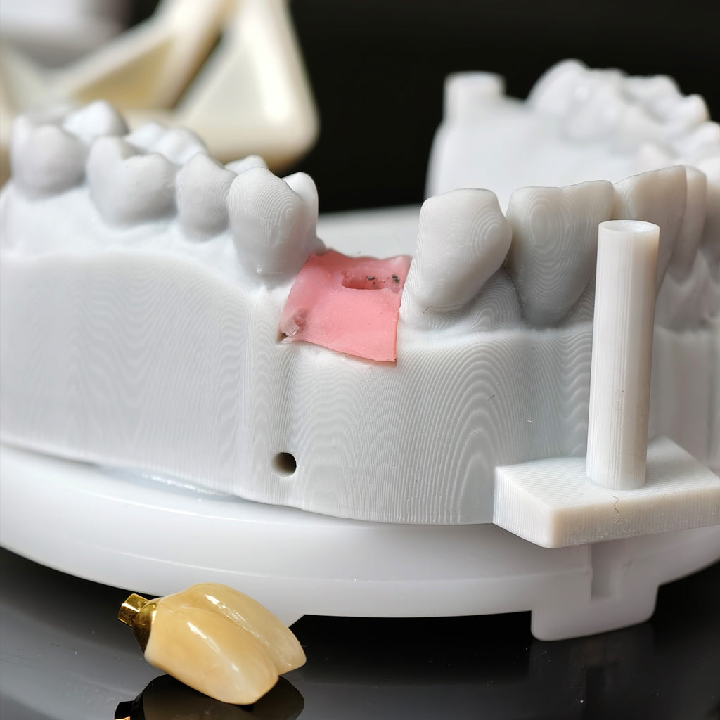 Zirconia Implant Crown With Gold Plating