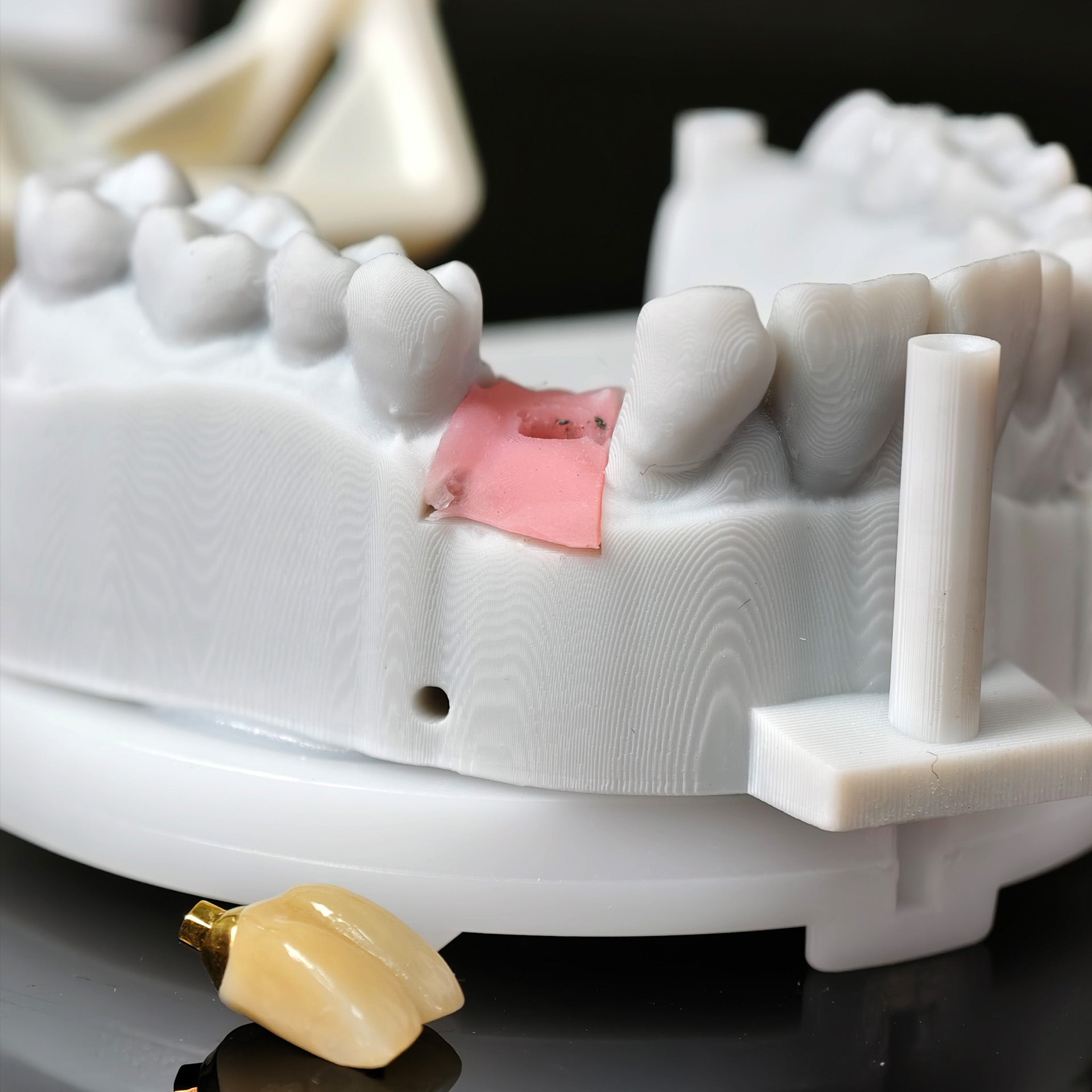 Zirconia Implant Crown With Gold Plating