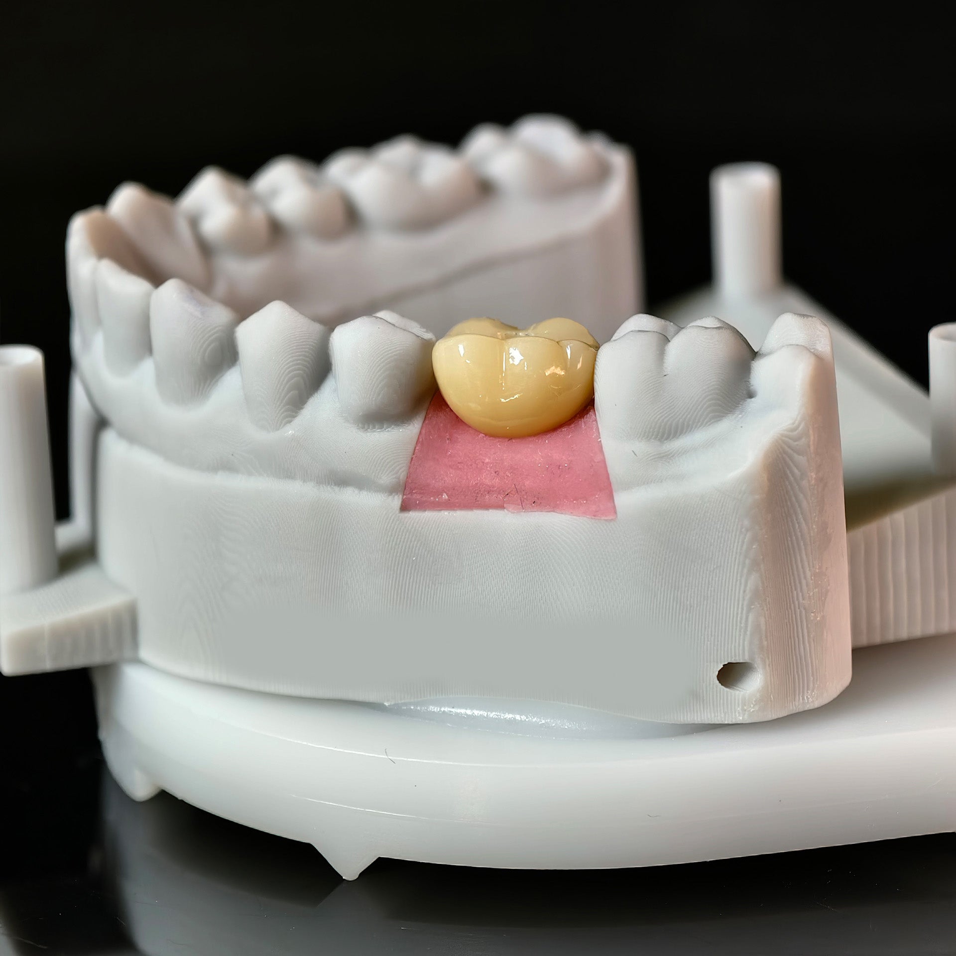 Zirconia Implant Crown With Gold Plating