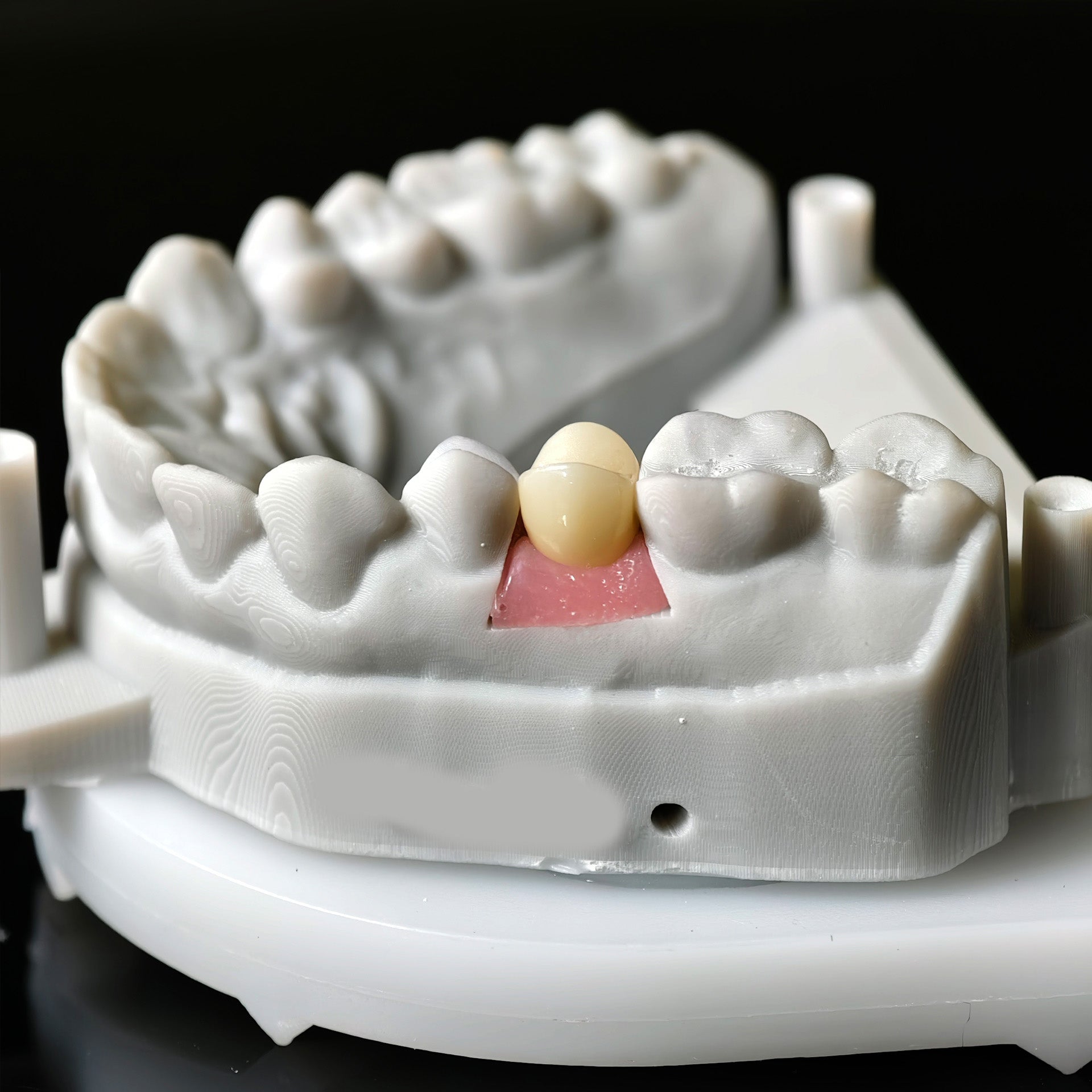 Zirconia Implant Crown With Gold Plating