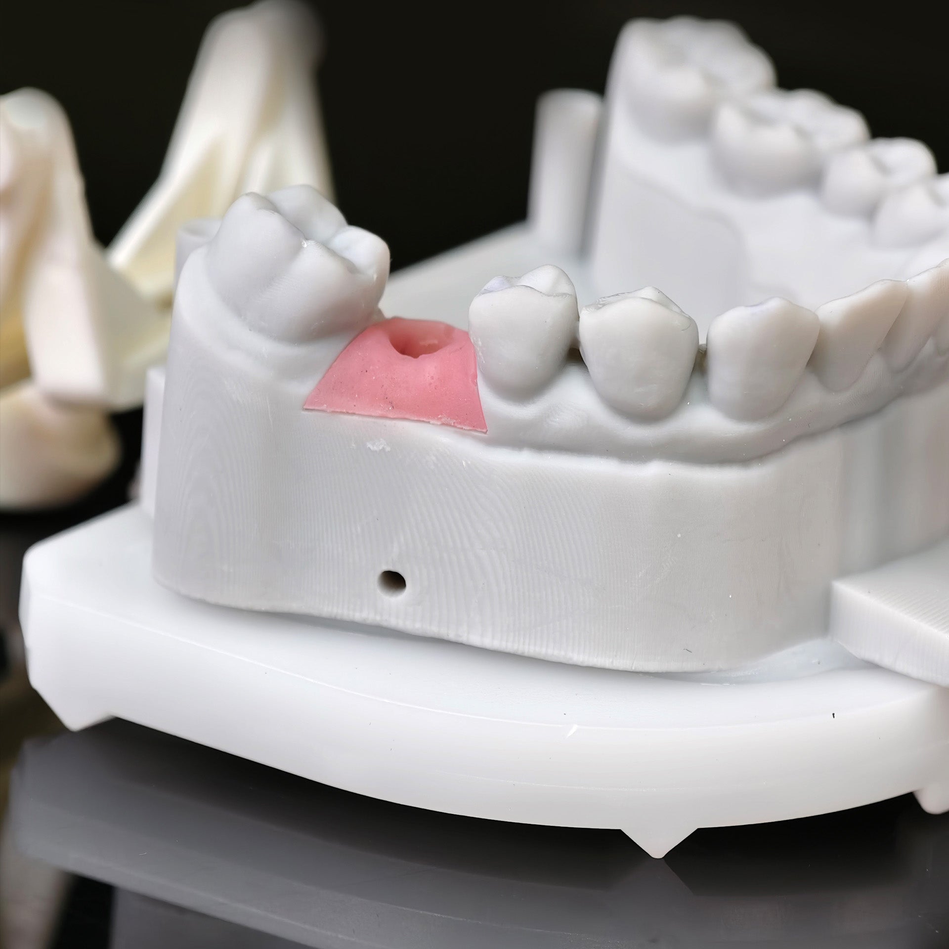 Zirconia Implant Crown With Gold Plating