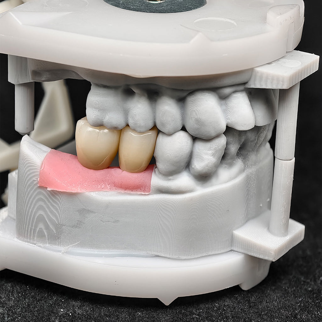 Custom Zirconia Implant Crowns