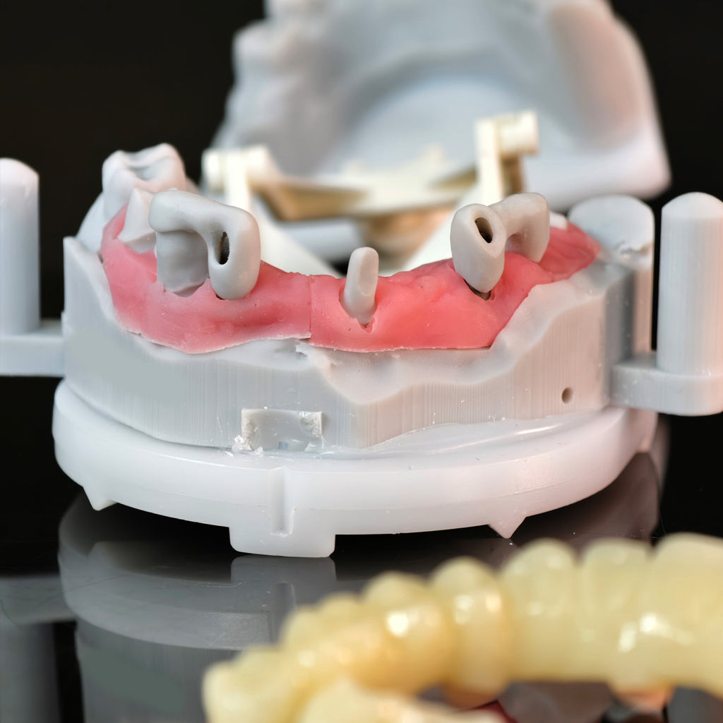 Custom Abutment And PMMA Bridge And Crown With Cement Retained