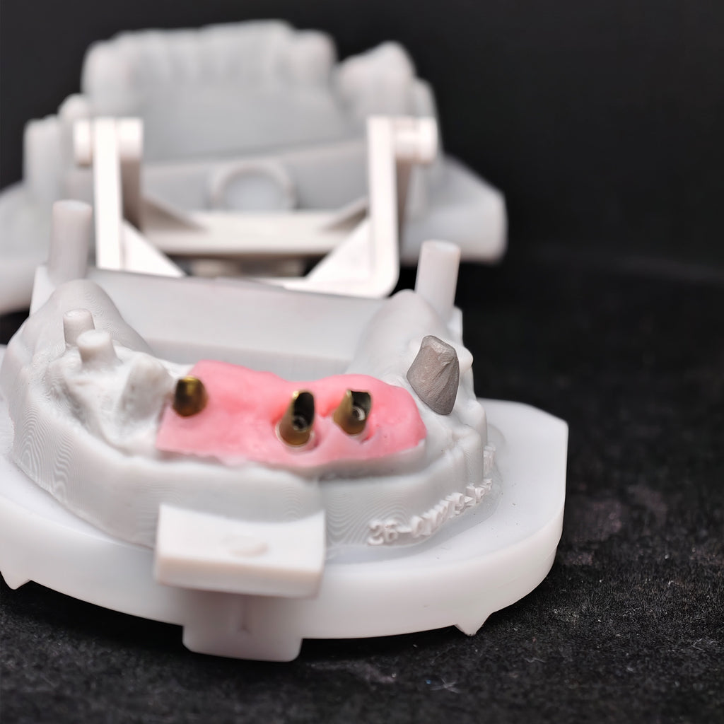 Custom Abutment With Zirconia Crown And Bridge