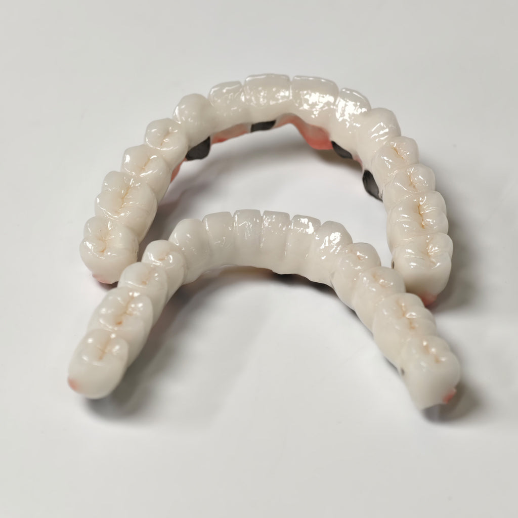 Full-Arch PFM Bridge With Screw Retained