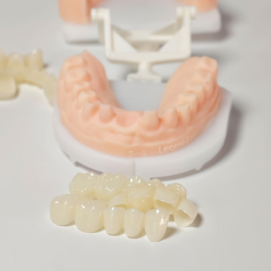 Full-Mouth Segmented PMMA Bridge With Cement Retained