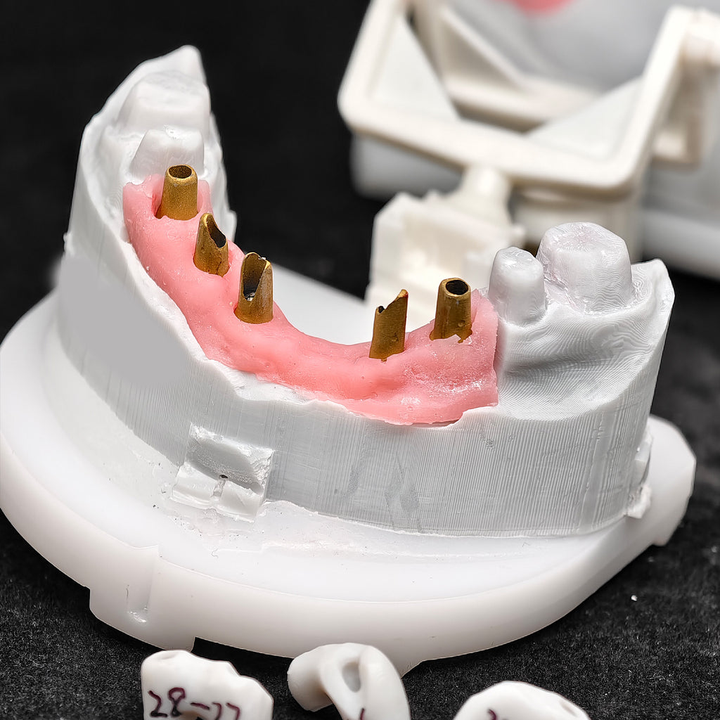 Pmma Bridge With Implant Seating Guide And Cemented