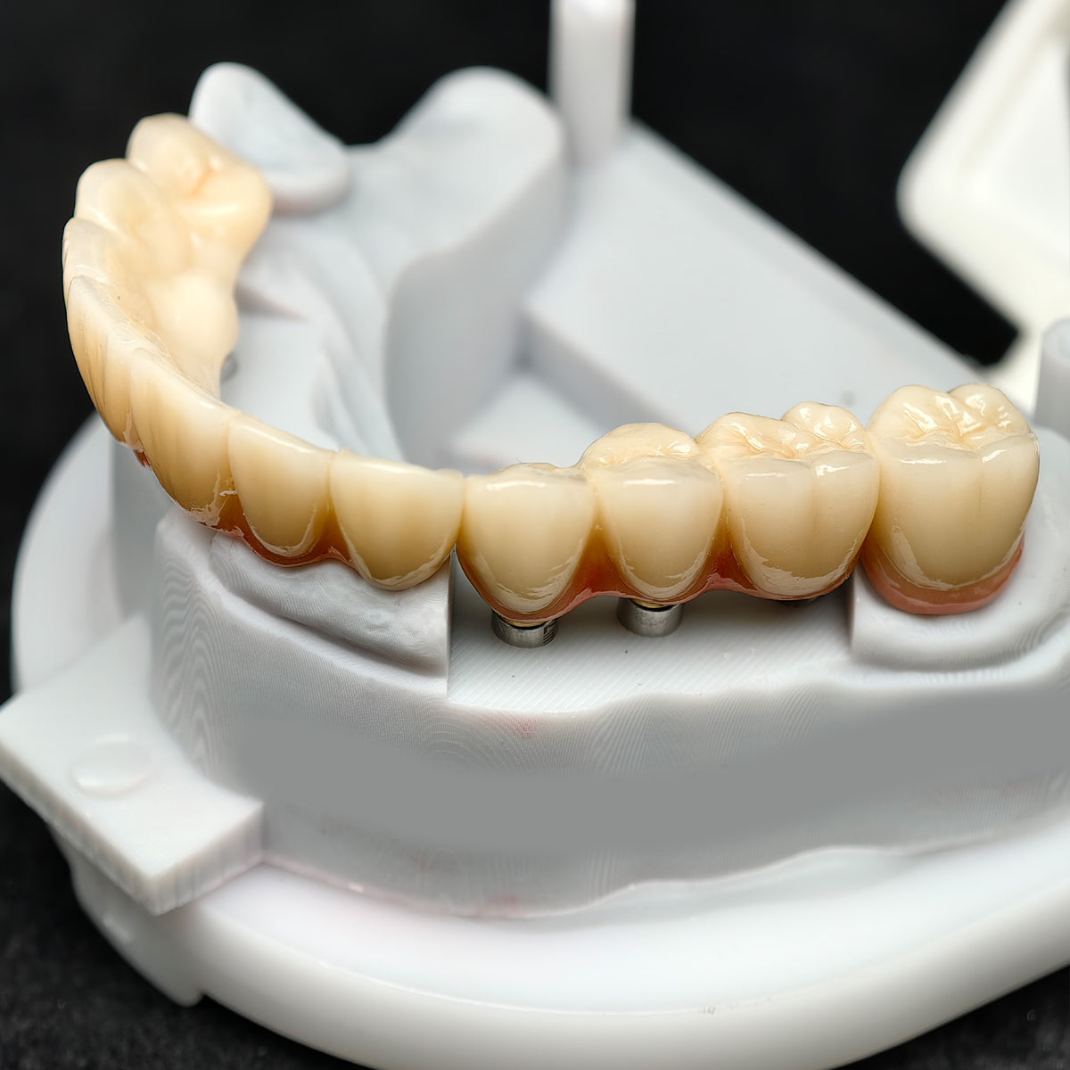 Zirconia Crown And Birdge With Cemented And Implant Seating Guide