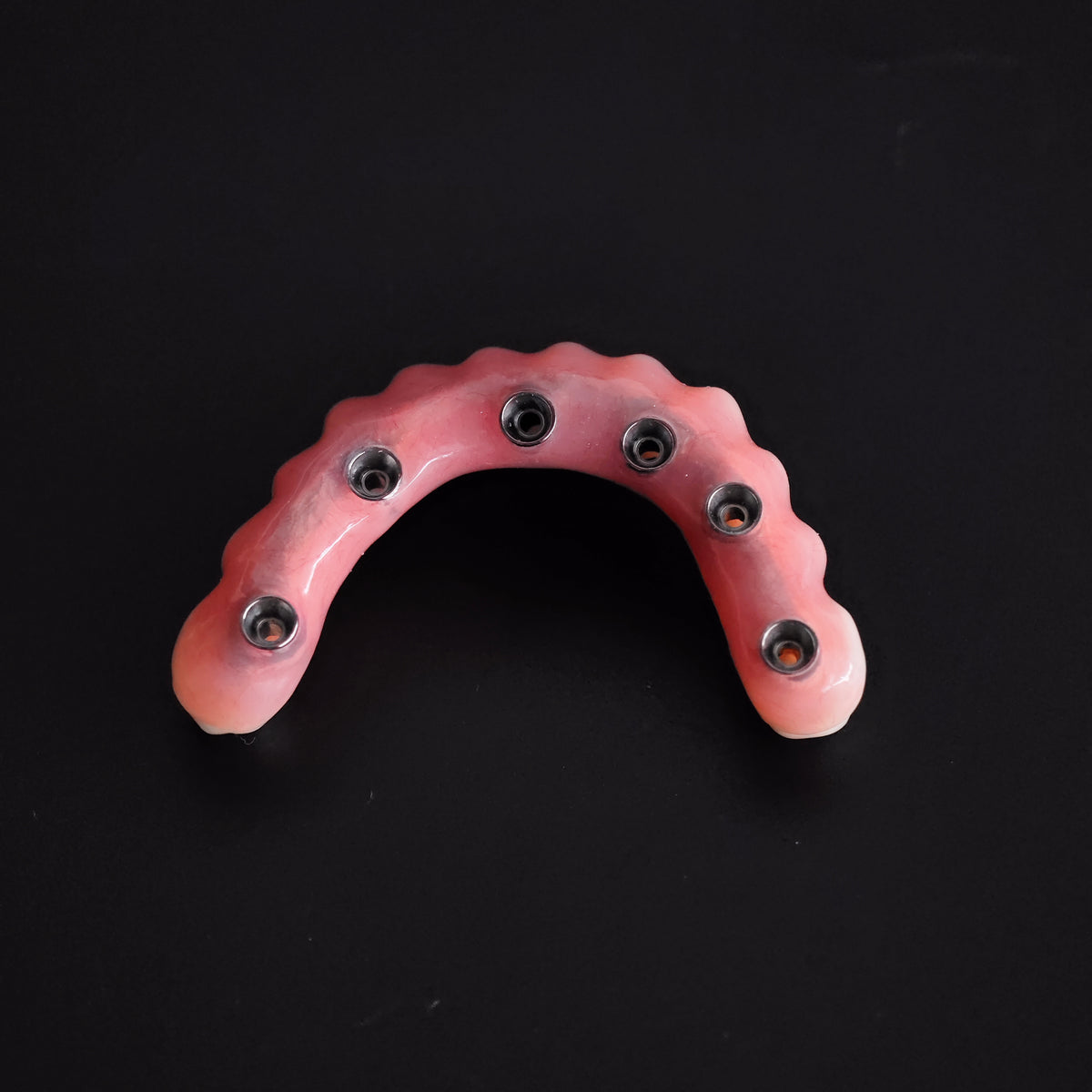 An Acrylic Denture With A Titanium Bar (Ti-Bar) Cost-Effective Full Arch Restoration Screw Retained
