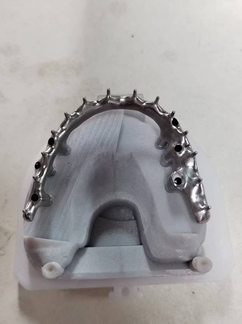 An Acrylic Denture With A Titanium Bar (Ti-Bar) Cost-Effective Full Arch Restoration Screw Retained