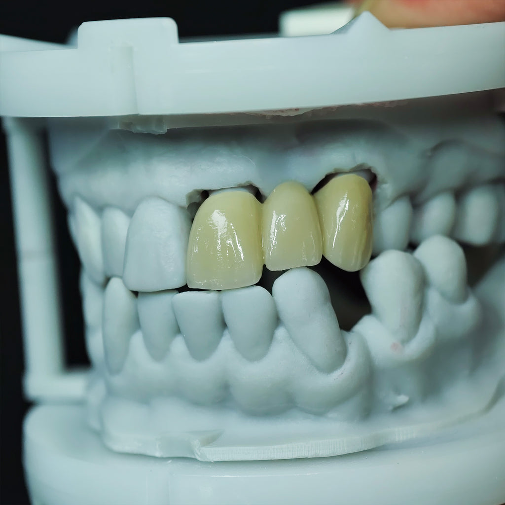 Beautiful Zirconia Bridge