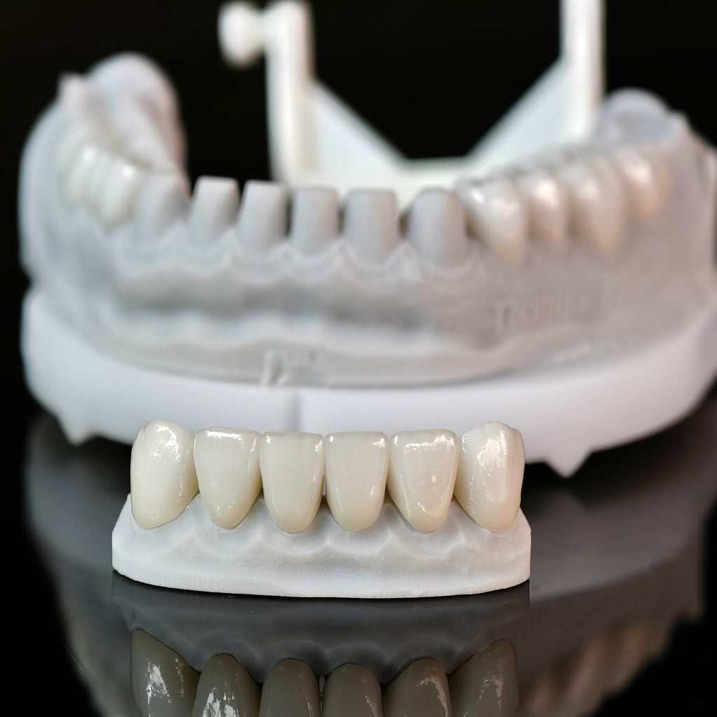 Ceramic Veneers And Crown With Cement Retained