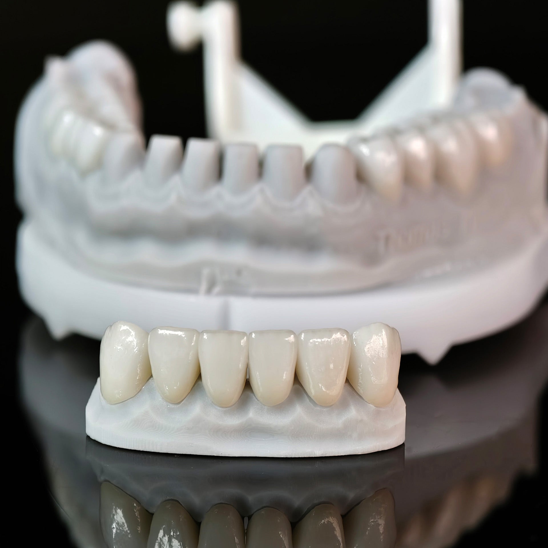 Ceramic Veneers And Crown With Cement Retained
