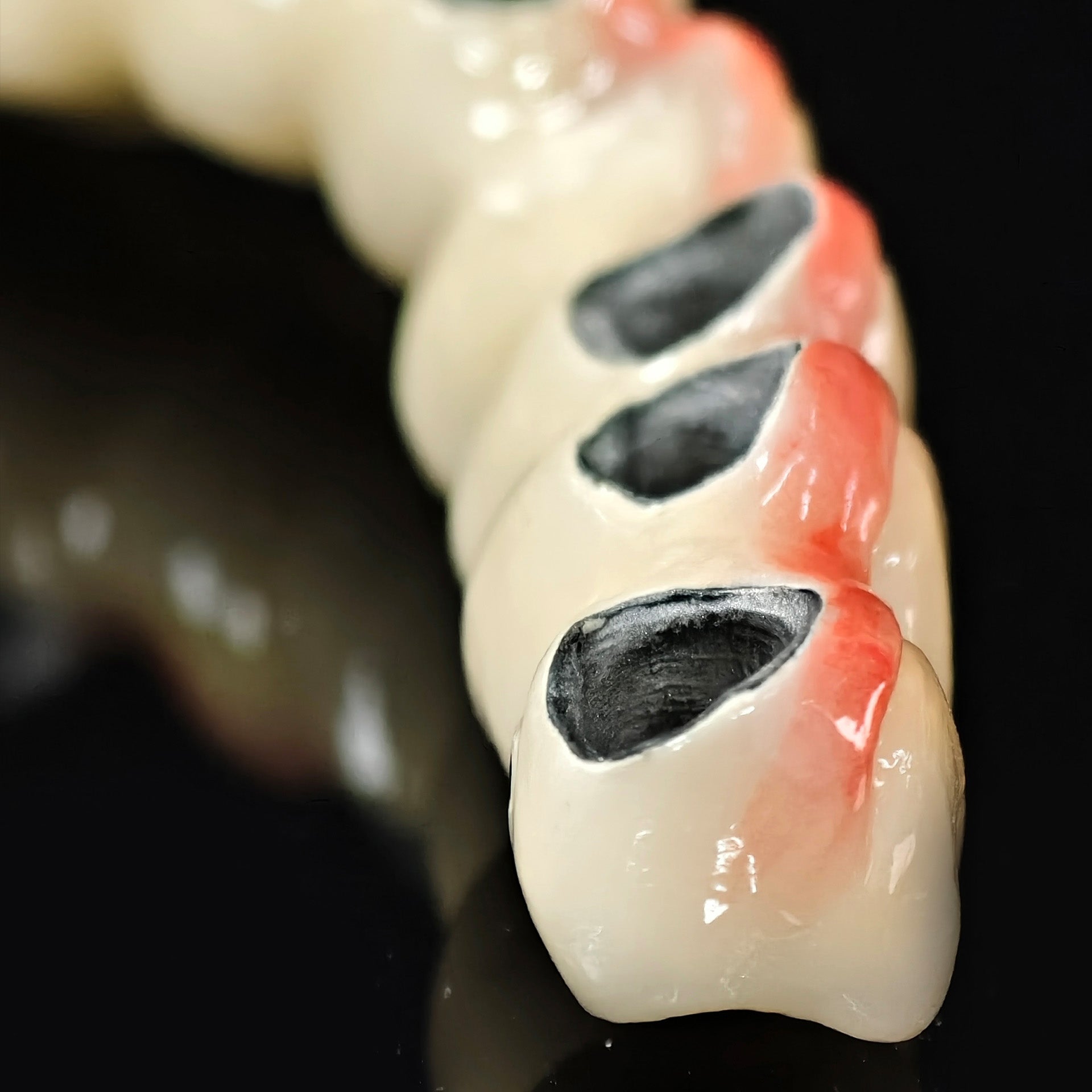 Co - Cr PFM Dental Bridge