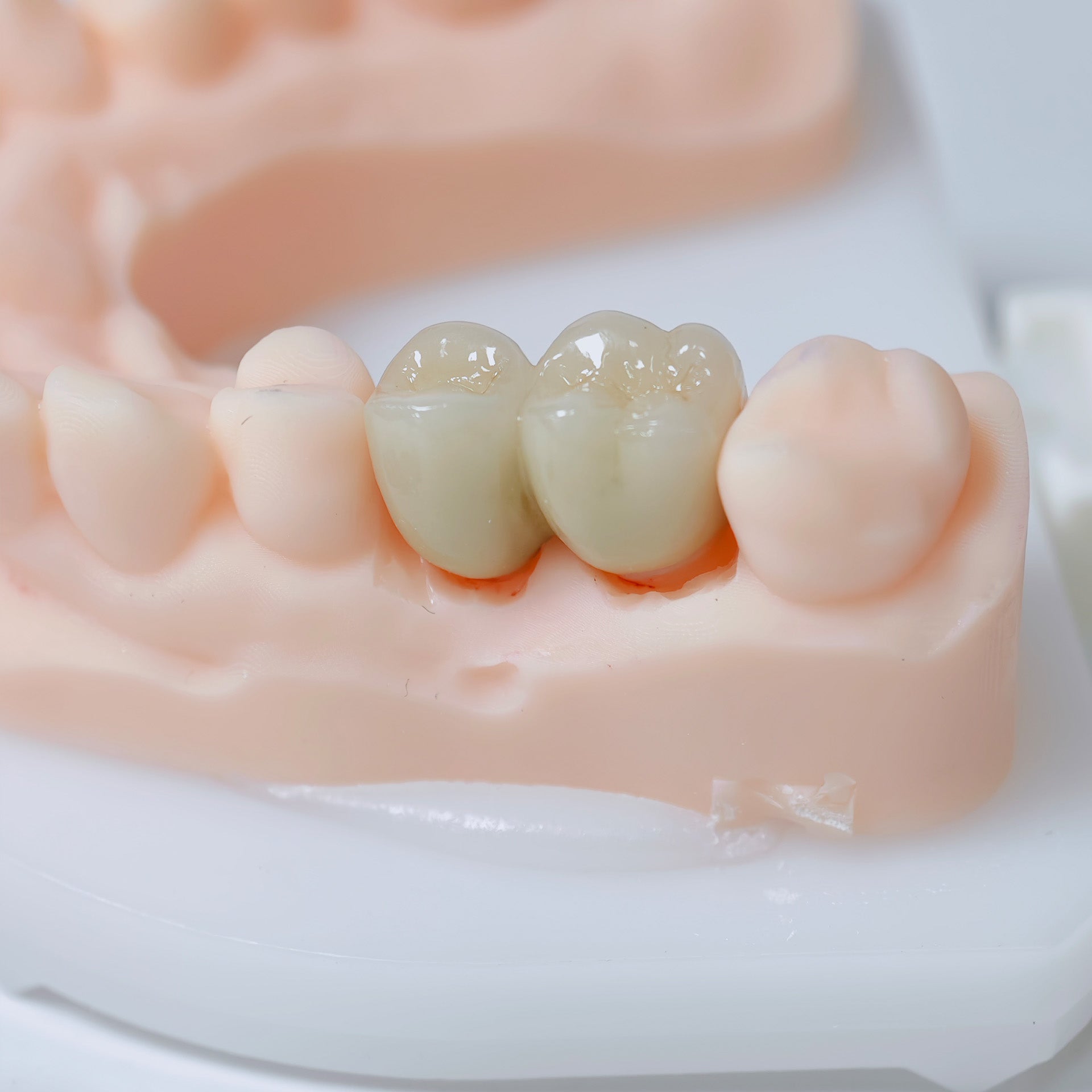 Co - Cr Pfm Dental Crowns And Bridge