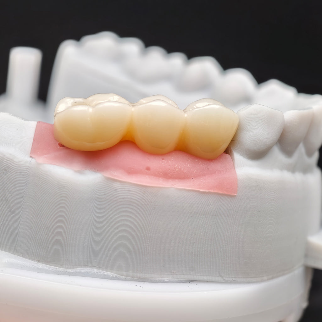 Custom Zirconia Implant Bridge