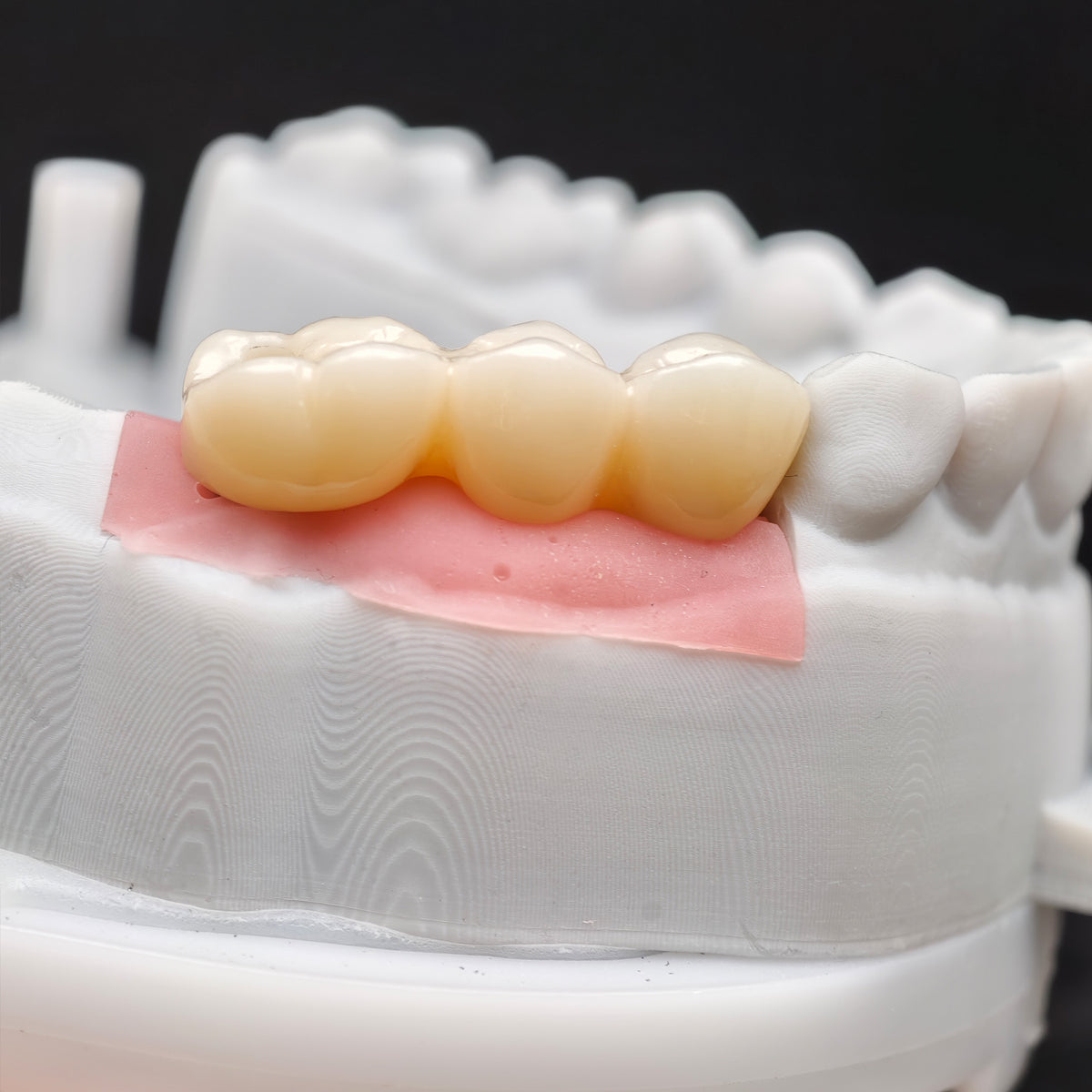 Custom Zirconia Implant Bridge