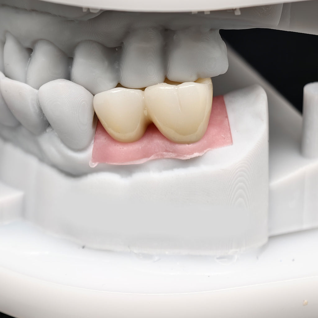 Custom Zirconia Implant Bridge
