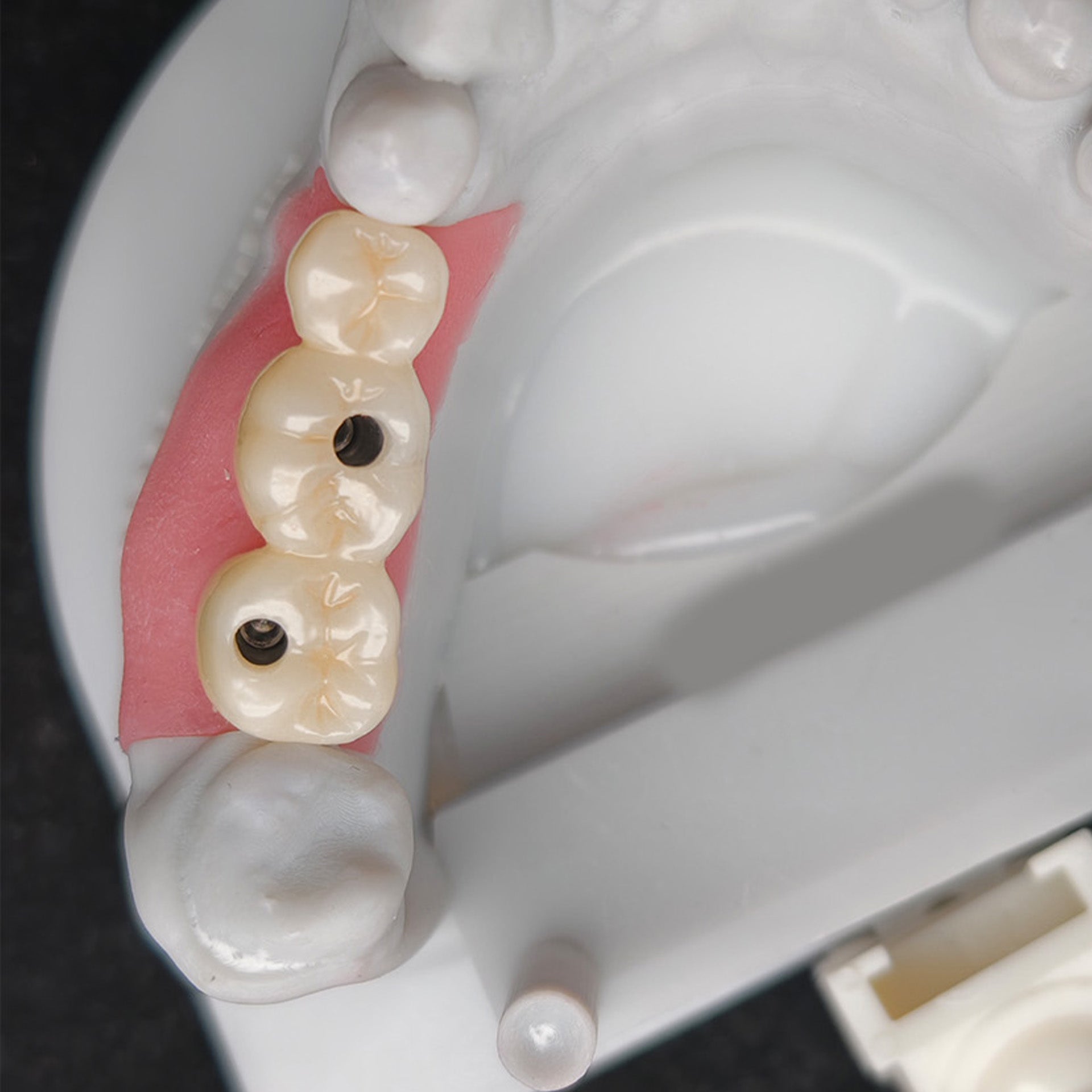 Custom Zirconia Implant Bridge