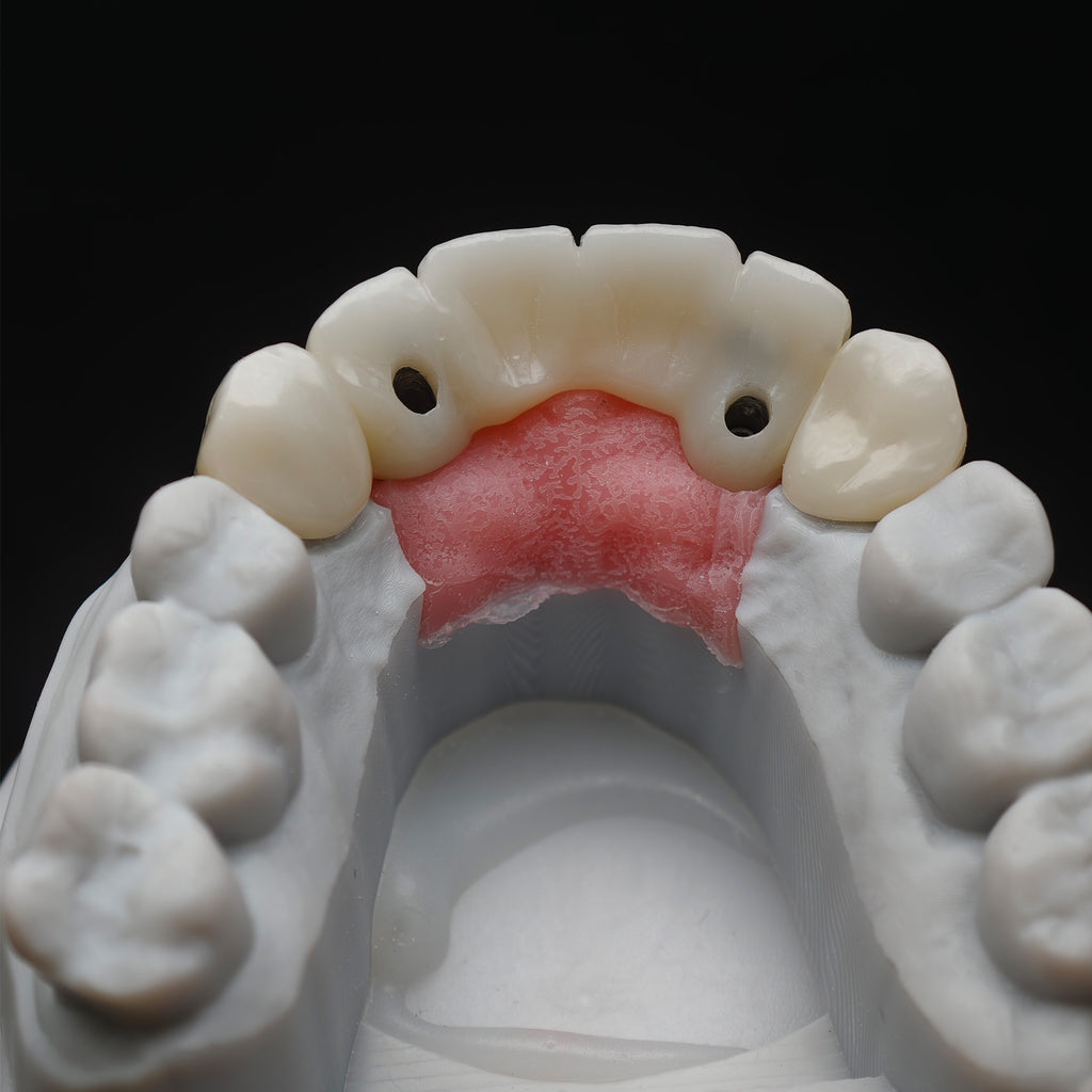Custom Zirconia Implant Bridge