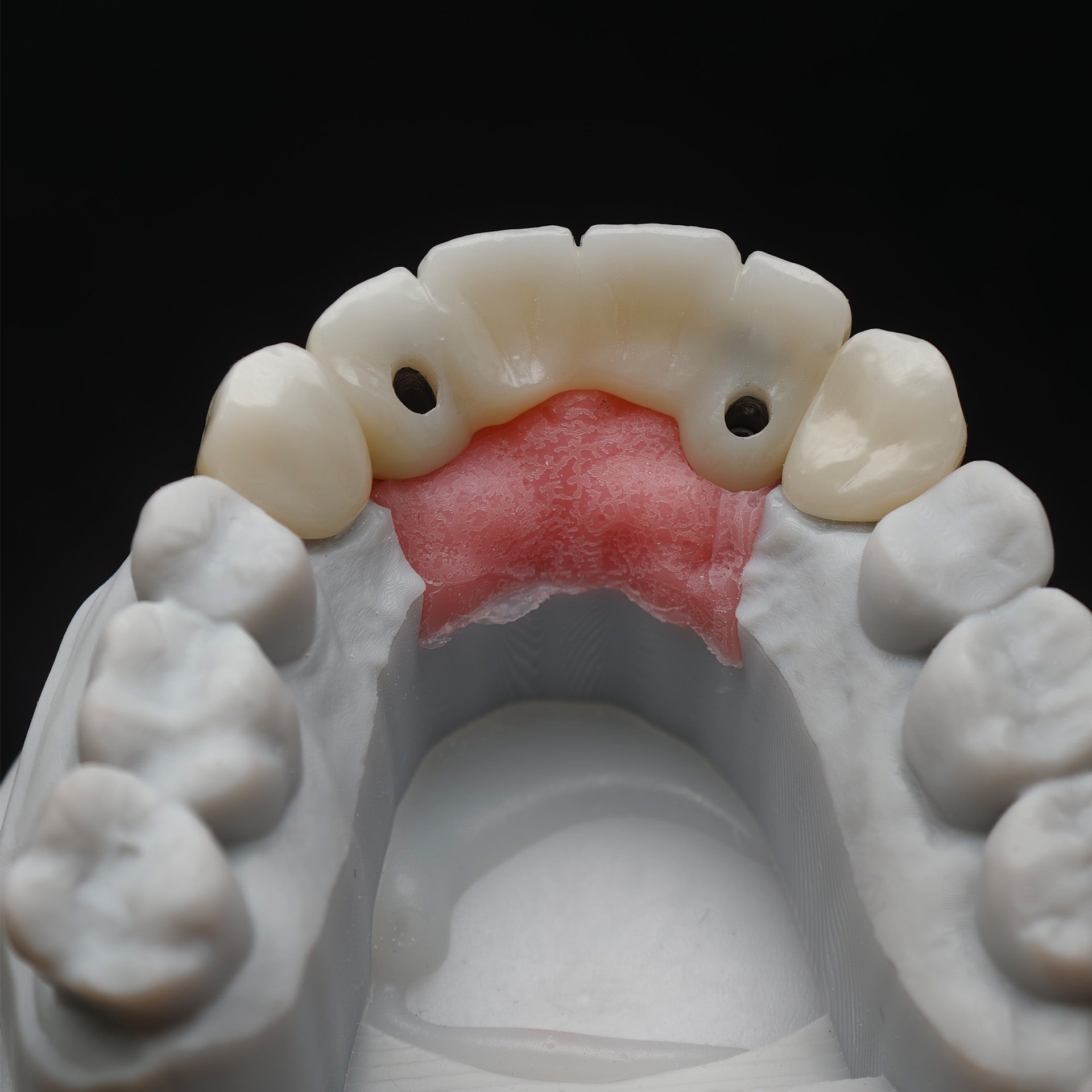 Custom Zirconia Implant Bridge