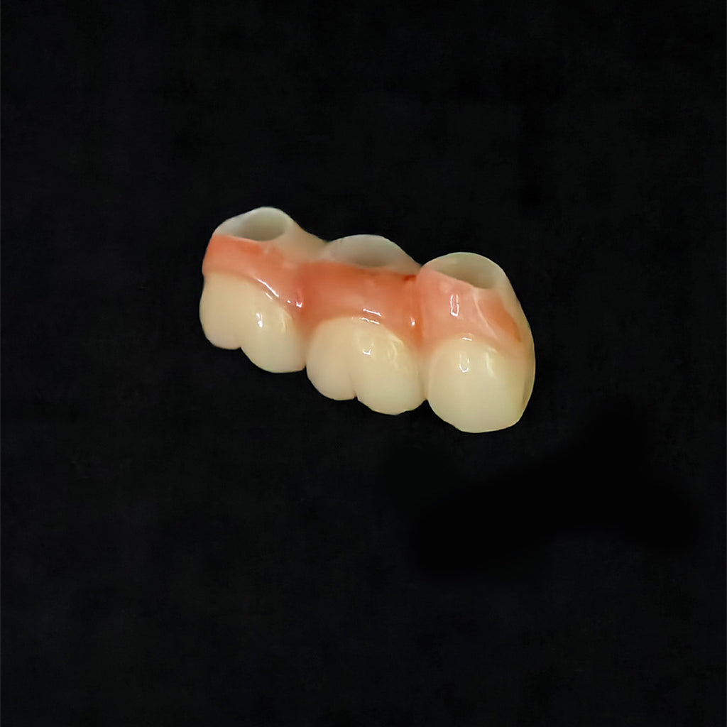 Custom Zirconia Implant Bridge
