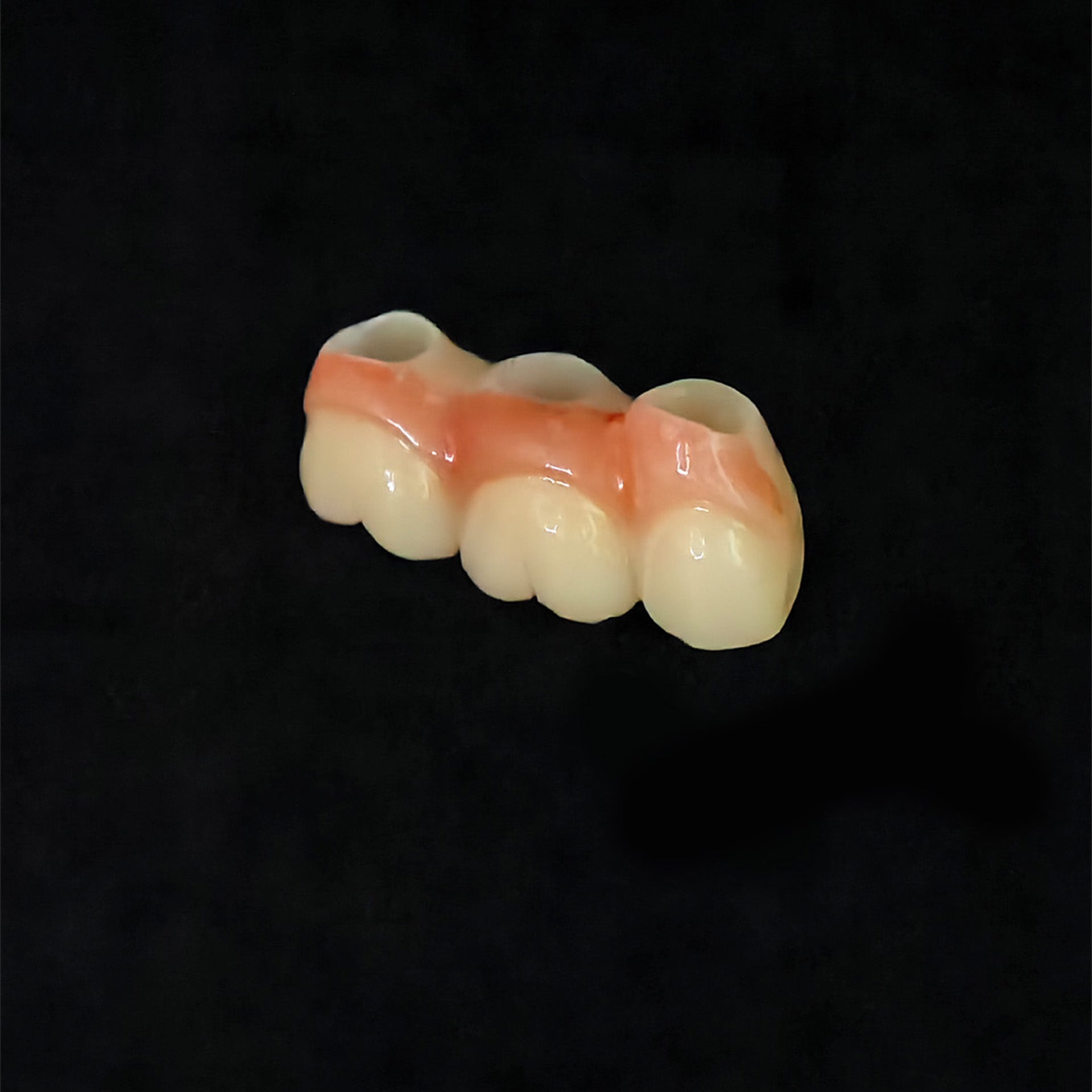 Custom Zirconia Implant Bridge