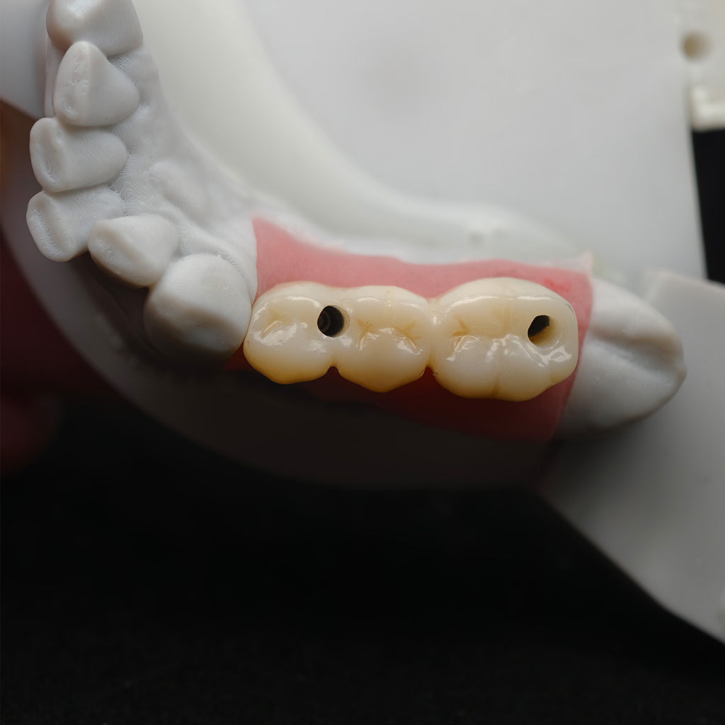 Custom Zirconia Implant Bridge