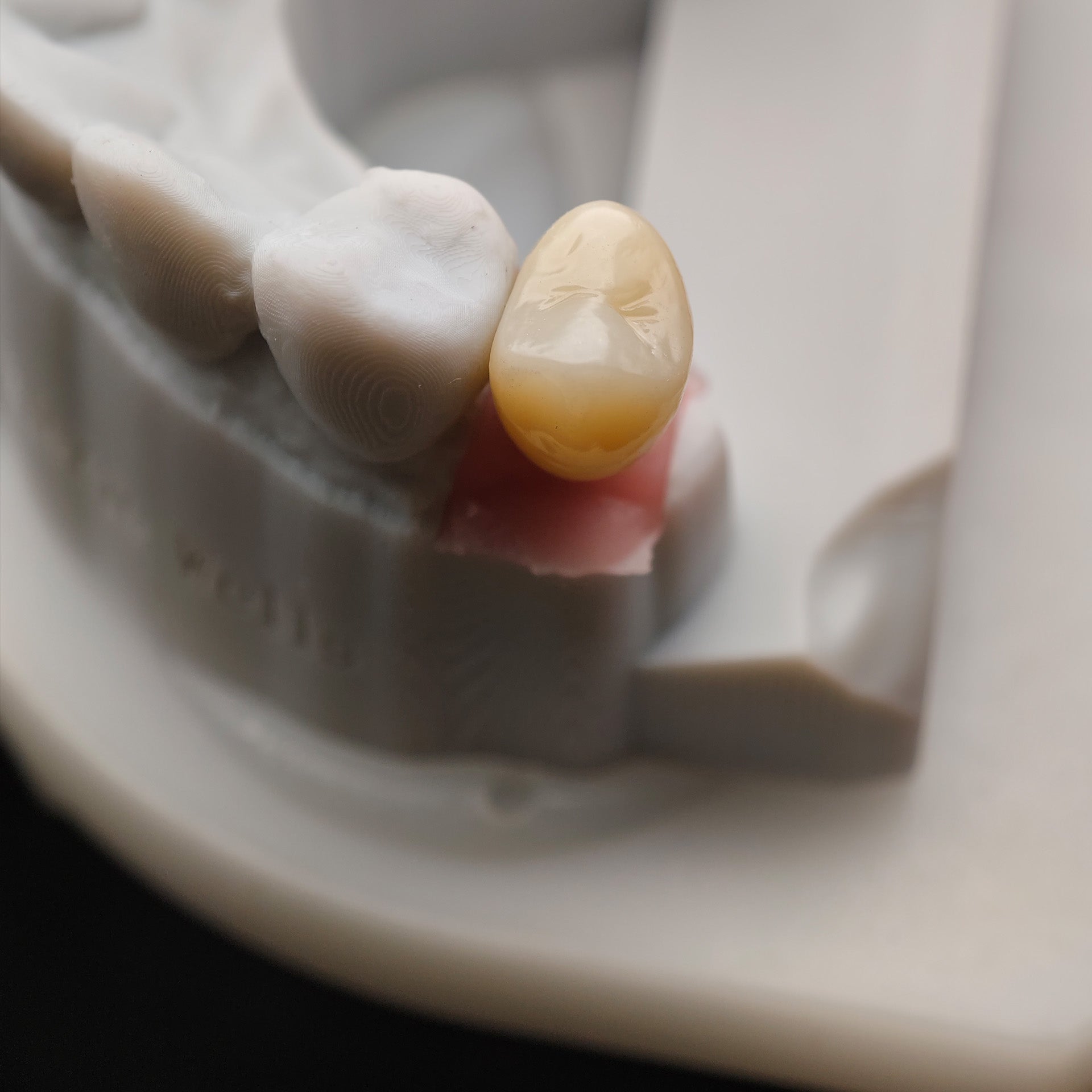 Custom Zirconia Implant Crown