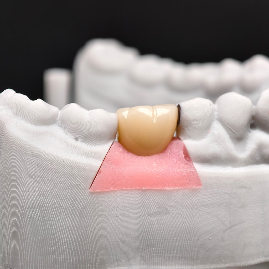Custom Zirconia Implant Crown