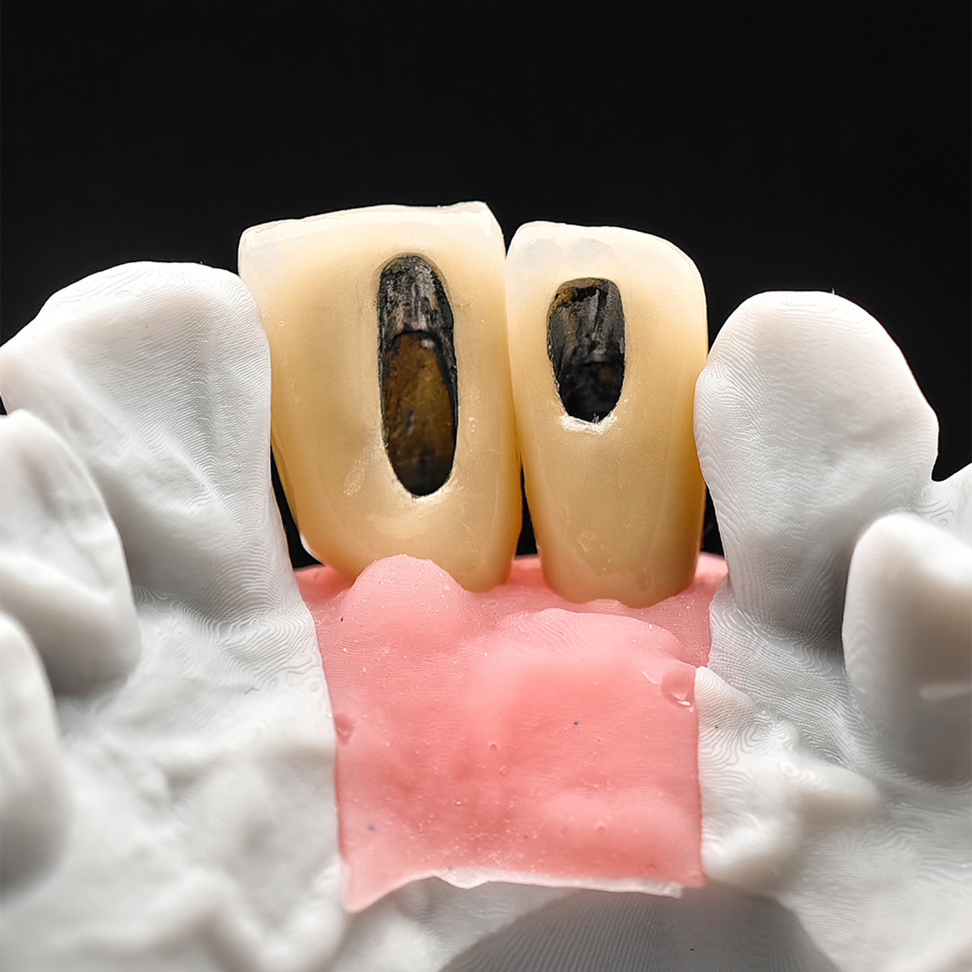 Custom Zirconia Implant Crowns